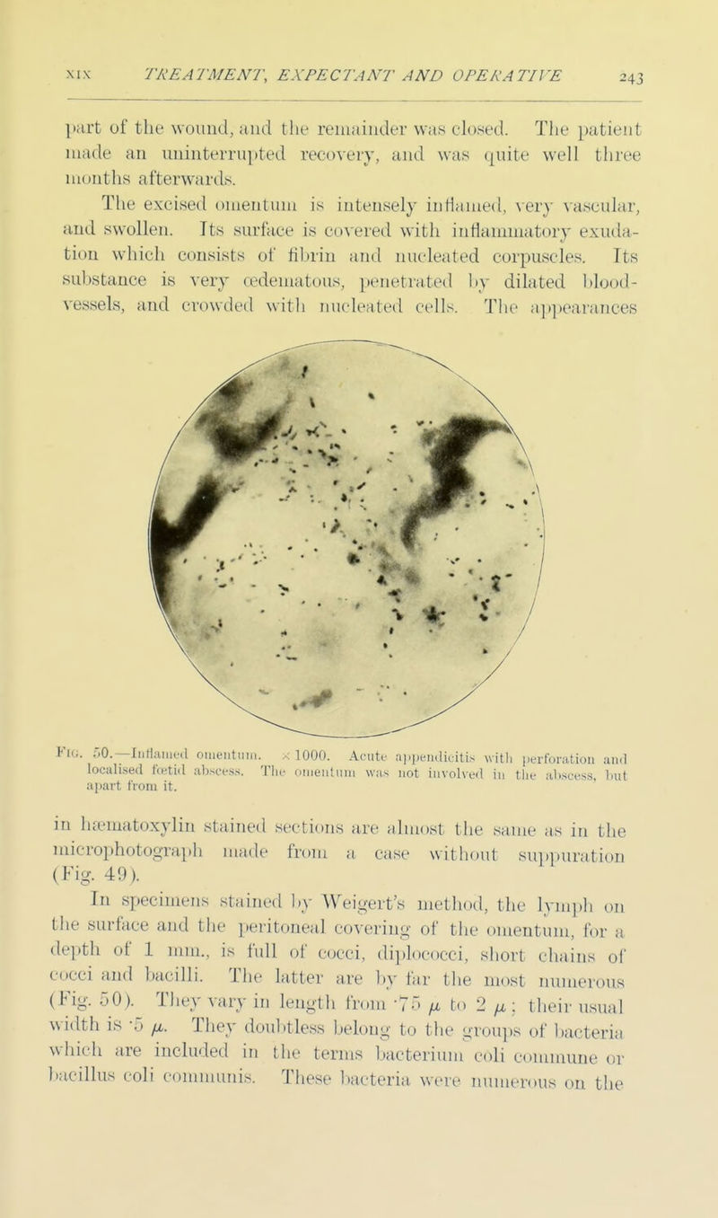 part of the wound, and the remainder was closed. The patient made an uninterrupted recovery, and was quite well three months afterwards. The excised omentum is intensely inflamed, very vascular, and swollen. Its surface is covered with inflammatory exuda- tion which consists of fibrin and nucleated corpuscles. Its substance is very oedematous, penetrated by dilated blood- vessels, and crowded with nucleated cells. The appearances Fig. 50.— Inflamed omentum, x 1000. Acute appendicitis with perforation ami localised foetid abscess. Tin- omentum was not involved in the abscess, but apart from it. in hematoxylin stained sections arc almost the same as in the microphotograph made from a case without suppuration (Fig. 49). In specimens stained by Weigert's method, the Lymph on the surface and the peritoneal covering of the omentum, lor a depth of 1 mm., is full of cocci, diplococci, short chains of cocci and bacilli. The latter are by far the most numerous (Fig. 50). They vary in length from '75 fi to 2 /x : their usual width is -5 fx. They doubtless belong to the groups of bacteria which are included in the terms bacterium coli commune or bacillus coli communis. These bacteria were numerous on the