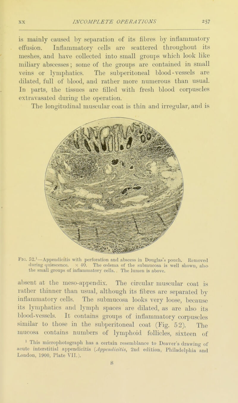 is mainly caused by separation of its fibres by inflammatory effusion. Inflammatory cells are scattered throughout its meshes, and have collected into small groups which look like miliary abscesses; some of the groups are contained in small veins or lymphatics. The subperitoneal blood-vessels are dilated, full of blood, and rather more numerous than usual. In parts, the tissues are filled with fresh blood corpuscles extravasated during the operation. The longitudinal muscular coat is thin and irregular, and is Fin. 52.1—Appendicitis with perforation and abscess in Douglas's poncli. Removed during quiescence. x 40. The oedema of the submucosa is well shown, also the small groups of inflammatory cells. The lumen is above. absent at the meso-appendix The circular muscular coat is rather thinner than usual, although its fibres are separated by inflammatory cells. The submucosa looks very loose, because its Lymphatics and lymph spaces are dilated, as arc also its blood-vessels. Jt contains groups of inflammatory corpuscles similar to those in the subperitoneal coat (Fig. 52). The mucosa, contains numbers of lymphoid follicles, sixteen of 1 This microphotograph has a certain resemblance to Deaver's drawing of acute interstitial appendicitis (Appendicitis, 2nd edition, Philadelphia and London, 1900, Plate VII. . S