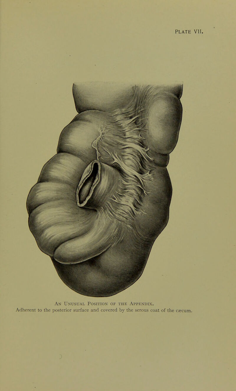 An Unusual Position of the Appendix. Adherent to the posterior surface and covered by the serous coat of the csecum.