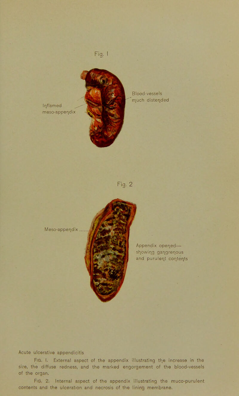 Iriflamed meso-appeqdix Meso-apper\dix. Acute ulcerative appendicitis Fig. I. External aspect of the appendix illustrating tl^e increase in the size, the diffuse redness, and the marked engorgement of the blood-vessels of the organ. Fig. 2. Internal aspect of the appendix illustrating the muco-purulent contents and the ulceration and necrosis of the lining membrane.