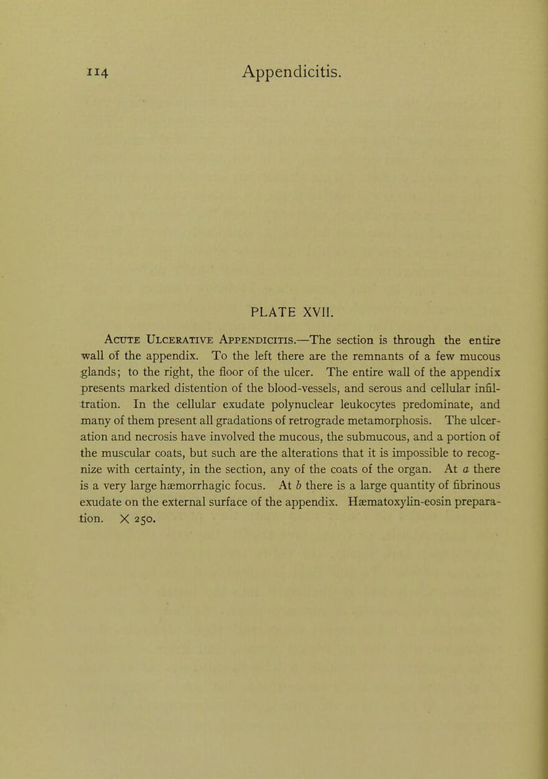 PLATE XVII. AciTTE Ulcerative Appendicitis.—The section is through the entire wall of the appendix. To the left there are the remnants of a few mucous glands; to the right, the floor of the ulcer. The entire wall of the appendix presents marked distention of the blood-vessels, and serous and cellular infil- tration. In the cellular exudate polynuclear leukocytes predominate, and many of them present all gradations of retrograde metamorphosis. The ulcer- ation and necrosis have involved the mucous, the submucous, and a portion of the muscular coats, but such are the alterations that it is impossible to recog- nize with certainty, in the section, any of the coats of the organ. At a there is a very large haemorrhagic focus. At b there is a large quantity of fibrinous exudate on the external surface of the appendix. Haematoxylin-eosin prepara- tion. X 250.