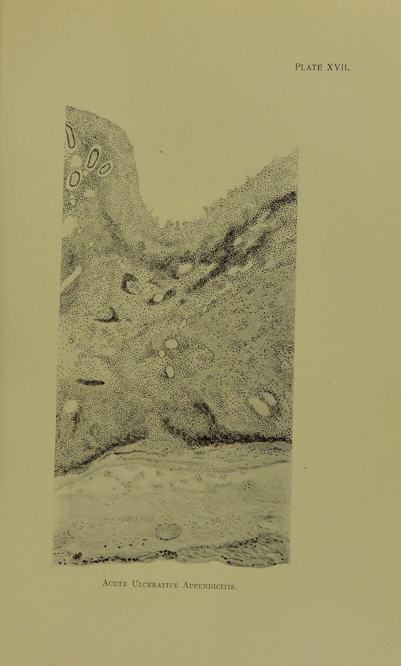 Acute Ulcerative Appendicitis.