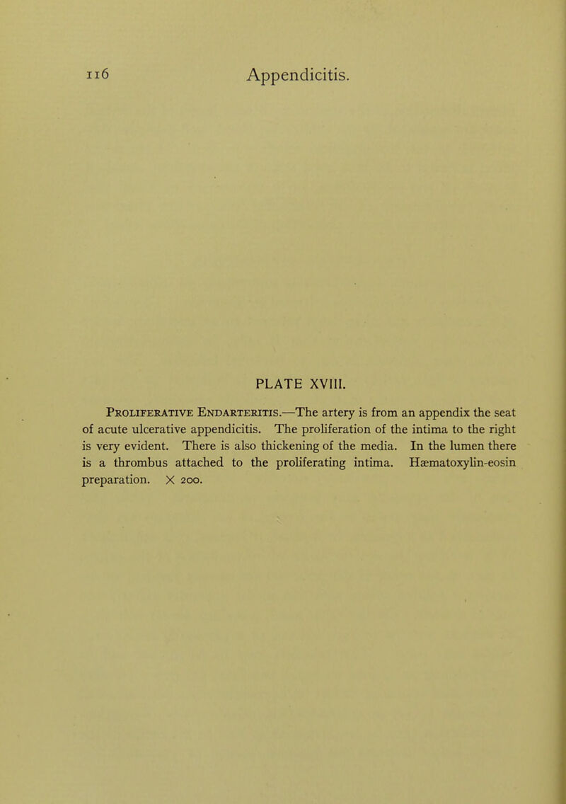 PLATE XVIII. Proliferative Endarteritis.—The artery is from an appendix the seat of acute ulcerative appendicitis. The proliferation of the intima to the right is very evident. There is also thickening of the media. In the lumen there is a thrombus attached to the proliferating intima. HaematoxyUn-eosin preparation. X 200.