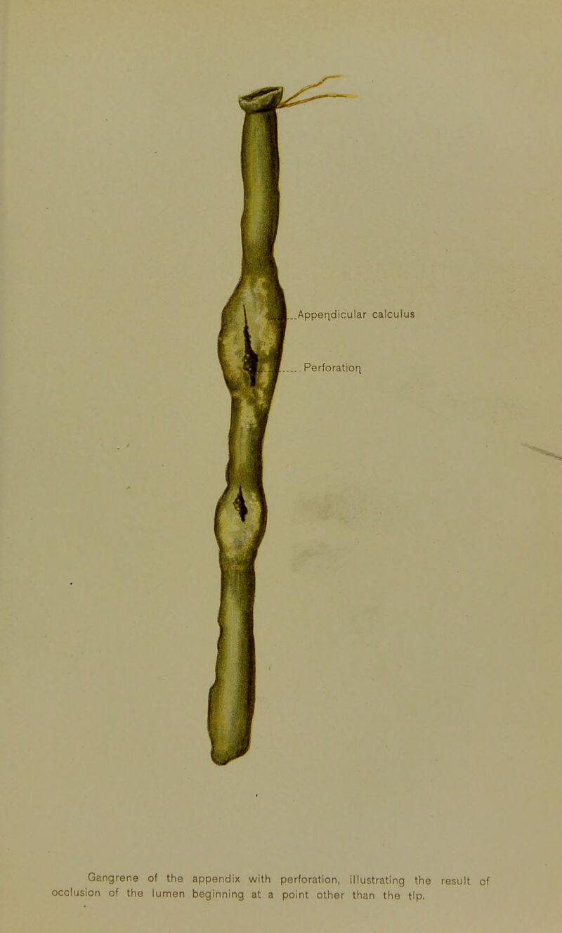 Gangrene of the appendix with perforation, illustrating the result of occlusion of the lumen beginning at a point other than the tip.