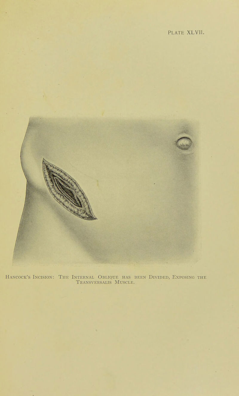 Hancock's Incision: The Internal Odlique has been Divided, Exposing the Transversalis Muscle.