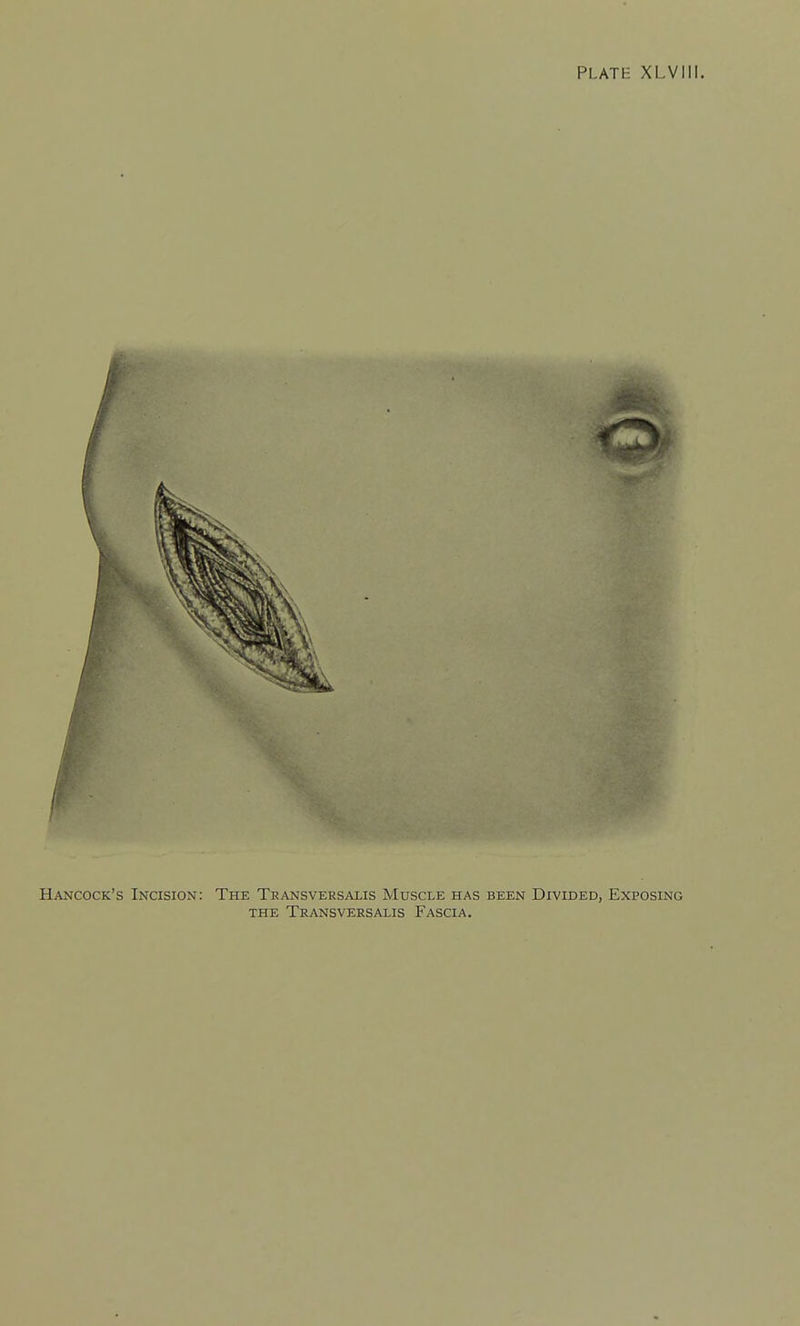 Hancock's Incision: The Transveesaijs Muscle has been Divided, Exposing THE TrANSVEESALIS FASCIA.