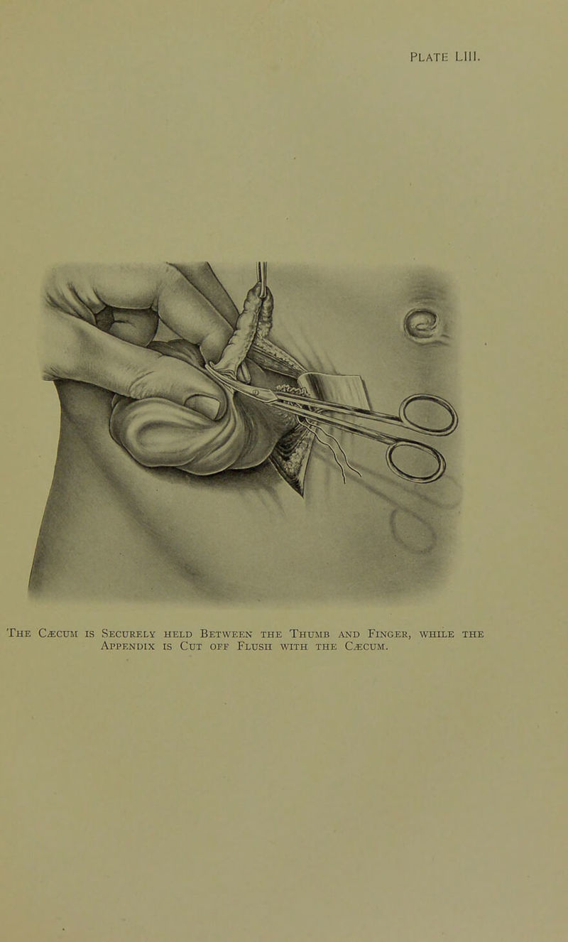 The CiECUM is Securely held Between the Thxjmb and Finger, while the Appendix is Cut off Flush with the C^cum.