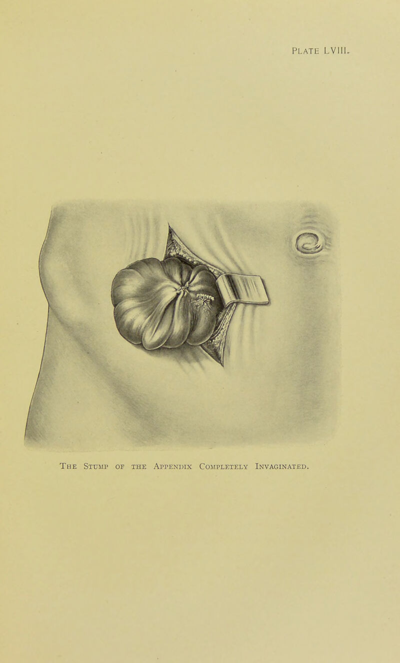 The Stump of the Appendix Completely Invaginated.