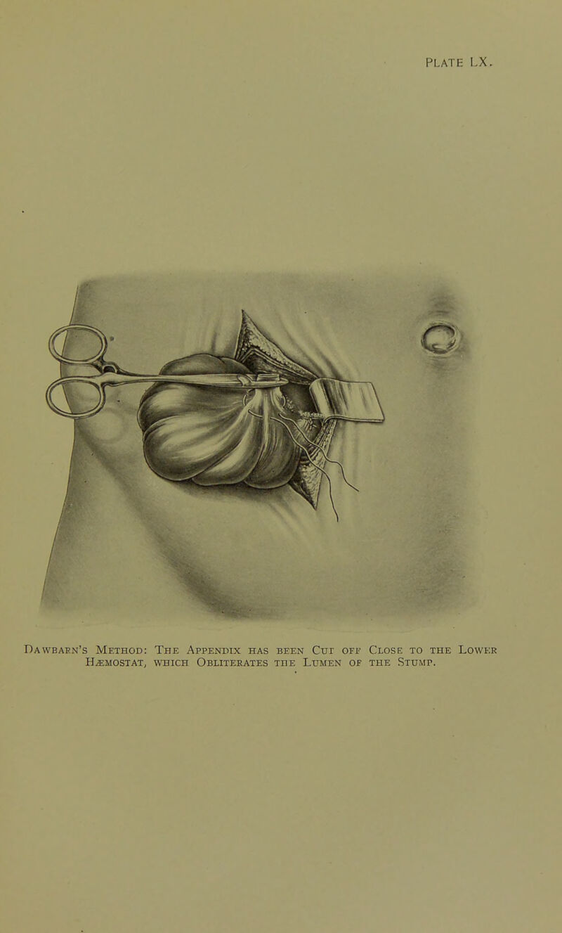 wbaen's Method: The Appendix has been Cur OFf Close to the Lowb;r UPMOST AT; WHICH OBLITERATES THE LuMEN OF THE StUMP.