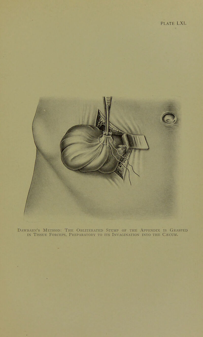 Dawbarn's Method: The Obliterated Stump of the Appendix is Grasped IN Tissue Forceps, Preparatory to its Invagination into the C^cum.