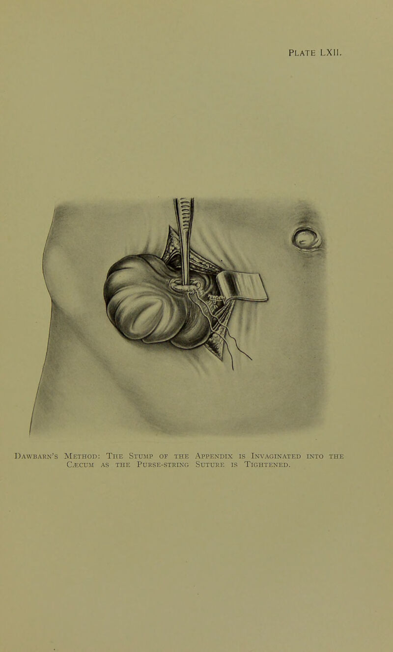 Dawbarn's Method: The Stump of the Appendix is Invaginated into the c/ecum as the purse-string suture is tightened.