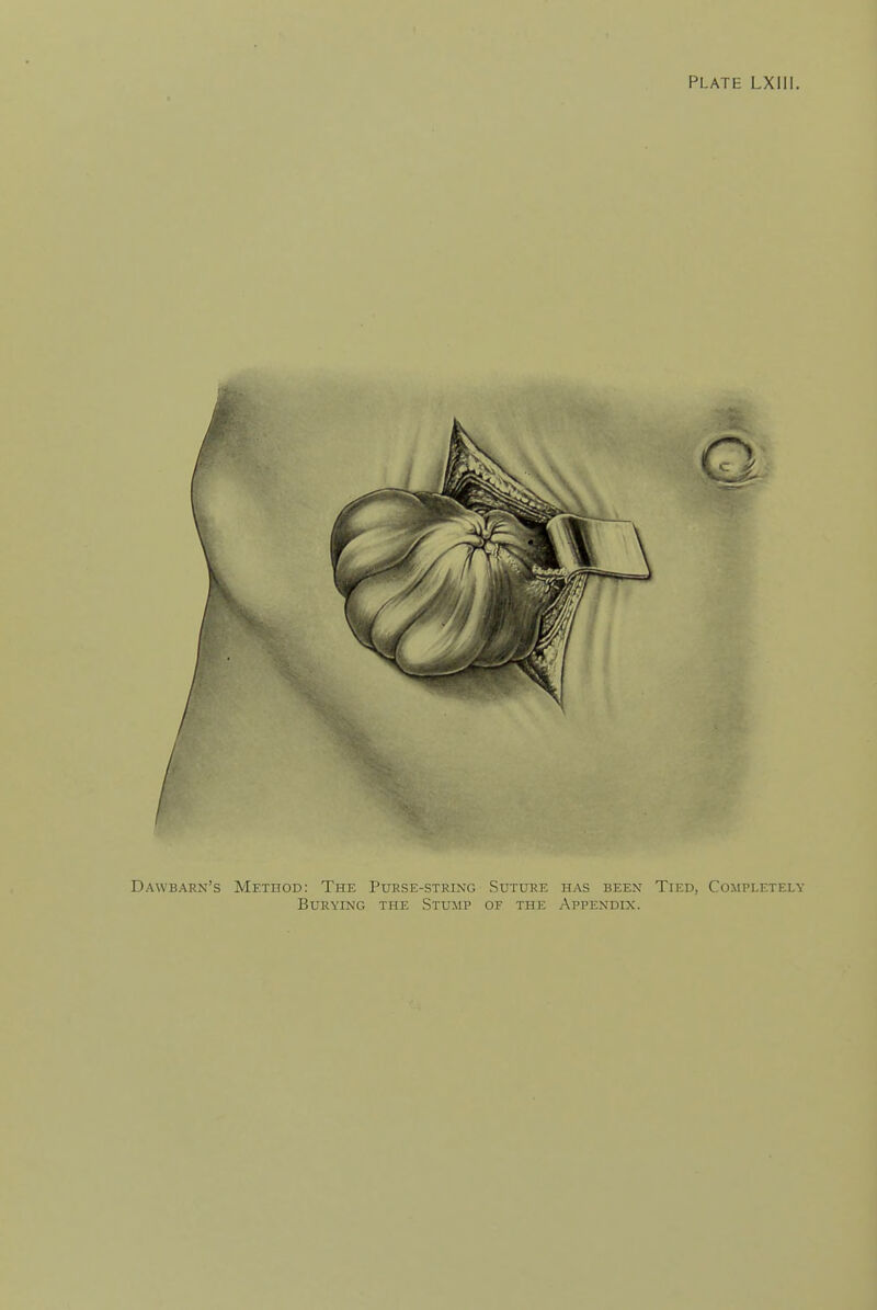 Dawbarn's Method: The Pukse-strixg Suture has been Tied, Completely Burying the Stump of the Appendix.