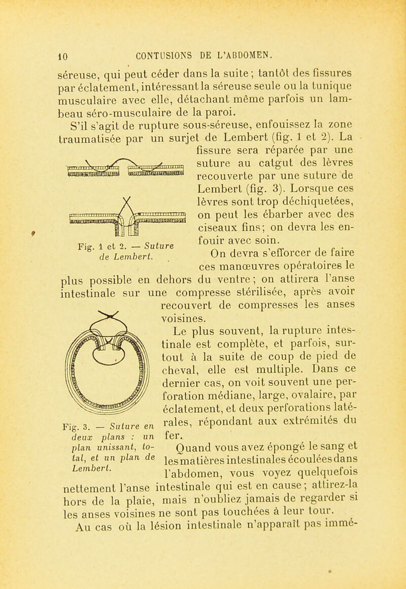 séreuse, qui peut céder dans la suite; tantôt des fissures par éclatement, intéressant la séreuse seule ou la tunique musculaire avec elle, détachant même parfois un lam- beau séro-musculaire de la paroi. S'il s'agit de rupture sous-séreuse, enfouissez la zone traumatisée par un surjet de Lembert (fig. 1 et 2). La fissure sera réparée par une suture au catgut des lèvres recouverte par une suture de Lembert (fig. 3). Lorsque ces lèvres sont trop déchiquetées, on peut les ébarber avec des ciseaux fins; on devra les en- fouir avec soin. On devra s'efforcer de faire ces manœuvres opératoires le plus possible en dehors du ventre; on attii'era l'anse intestinale sur une compresse stérilisée, après avoir recouvert de compresses les anses voisines. Le plus souvent, la rupture intes- tinale est complète, et parfois, sur- tout à la suite de coup de pied de cheval, elle est multiple. Dans ce dernier cas, on voit souvent une per- foration médiane, large, ovalaire, par éclatement, et deux perforations laté- rales, répondant aux extrémités du 1 et 2. — Suture de Lembert. Fig. 3. — Suture en deux plans : un plan unissant, to- tal, et un plan de Lembert. fer. Quand vous avez épongé le sang et les matières intestinales écoulées dans l'abdomen, vous voyez quelquefois nettement l'anse intestinale qui est en cause ; atlirez-la hors de la plaie, mais n'oubliez jamais de regarder si les anses voisines ne sont pas touchées à leur tour. Au cas où la lésion intestinale n'apparaît pas immé-