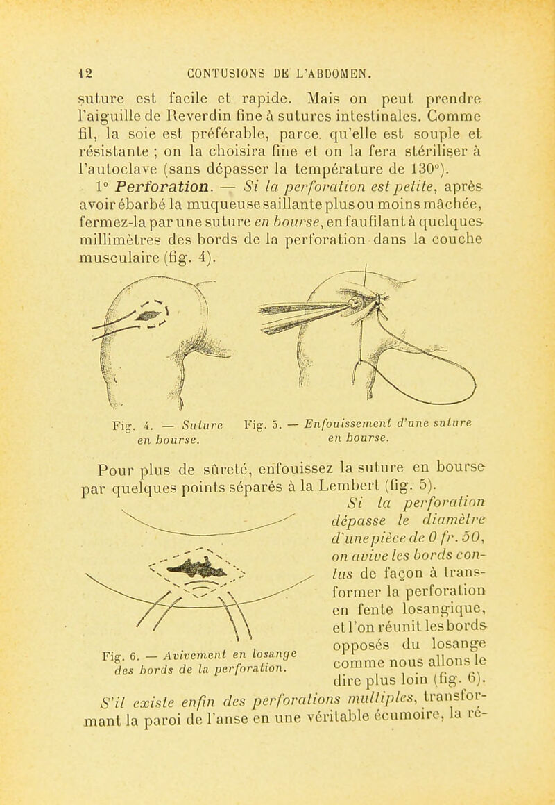 suture est facile et rapide. Mais on peut prendre l'aiguille de Reverdin fine à sutures intestinales. Comme fil, la soie est préférable, parce, qu'elle est souple et résistante ; on la choisira fine et on la fera stériliser à l'autoclave (sans dépasser la température de 130°). 1° Perforation. — Si la perforation estpeiile, après avoirébarbé la muqueuse saillante plusou moins mâchée, fei'mez-la par une suture en bourse, en faufilant à quelques millimètres des bords de la perforation dans la couche musculaire (fig. 4). . A. — Suture en bourse. Fig. 5. — Enfouissement d'une suture en bourse. Pour plus de sûreté, enfouissez la suture en bourse par quelques points séparés à la Lembert (fig. 5). Si la perforation dépasse le diamètre d'une pièce de 0 fr. 50, on avive les bords con- tus de façon à trans- former la perforation en fente losangique, et l'on réunit les bords opposés du losange comme nous allons le dire plus loin (fig. 6). Fig. 6. — Avivemenl en losange des bords de la perforation. S'il existe enfin des perforations multiples, transfor- mant la paroi de l'anse en une véritable écumoire, la re-