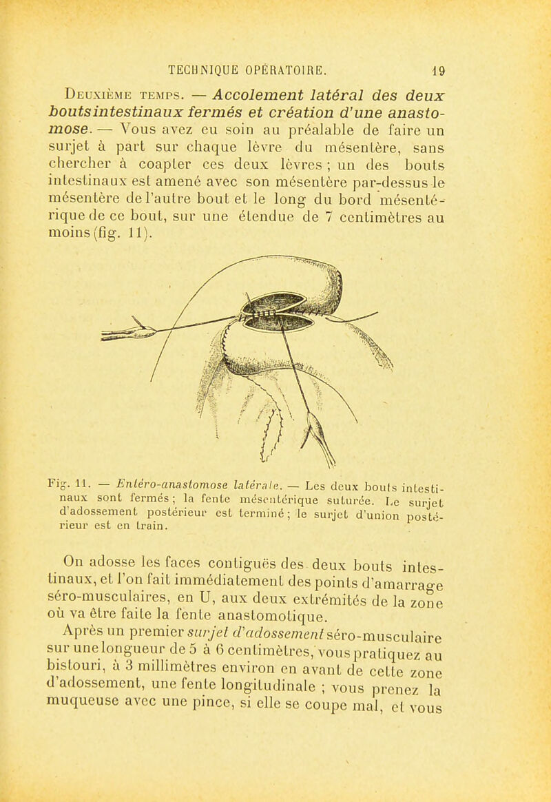 Deuxième temps. — Accolement latéral des deux bouts intestinaux fermés et création d'une anasto- mose. — Vous avez eu soin au préalable de faire un surjet à part sur chaque lèvre du mésentère, sans chercher à coapLer ces deux lèvres ; un des bouts intestinaux est amené avec son mésentère par-dessus le mésentère de l'autre bout et le long du bord mésenté- riquede ce bout, sur une étendue de 7 centimètres au moins (fig. 11). Fig-. 11. — Enléro-anastomose latérale. — Les deux bouts intesti- naux sont fermés; la fente mésontérique suturée. Le surjet d'adossement postérieur est terminé; le surjet d'union posté- rieur est en train. On adosse les faces contiguës des deux bouts intes- tinaux, et l'on fait immédiatement des points d'amarra^-e séro-musculaires, en U, aux deux extrémités de la zone où va être faite la fente anaslomotique. Après un premier s^/ye/ cl'adossement sévo-muscnlaire sur une longueur de 5 à 6 centimètres, vous pratiquez au bistouri, à 3 millimètres environ en avant de cette zone d'adossement, une fente longitudinale ; vous prenez la muqueuse avec une pince, si elle se coupe mal, cl vous
