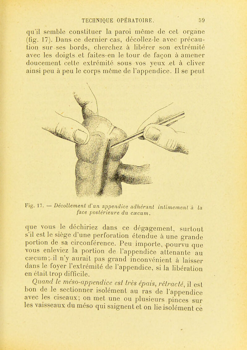 qu'il semble consLitiicr la paroi môme de ceL organe (fig. 17). Dans ce dernier cas, dccollcz-le avec précau- tion sur ses bords, cherchez à libérer son extrémité avec les doigts et faites-en le tour de façon à amener doucement cette extrémité sous vos yeux et à cliver ainsi peu à peu le corps môme de l'appendice. Il se peut \ Fig. 17. — Décollement d'un appendice adhérant inliinemanl h la face postérieure du cœcum. que VOUS le déchiriez dans ce dégagement, surtout s'il est le siège d'une perforation étendue à une grande portion de sa circonférence. Peu importe, pourvu que vous enleviez la portion de l'appendice attenante au cœcum; il n'y aurait pas grand inconvénient à laisser dans le foyer l'extrémité de l'appendice, si la hbération en était trop difficile. Quand le méso-appendice est Irès épais, rélraclé, il est bon de le sectionner isolément au ras de l'appendice avec les ciseaux; on met une ou plusieurs pinces sur les vaisseaux du méso qui saignent et on lie isolément ce