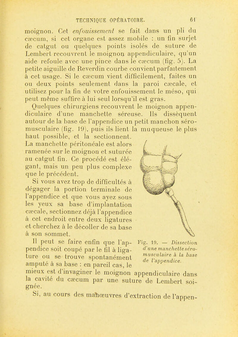 moignon. Cet enfouissement se fait dans un pli du csecum, si cet organe est assez mobile : un fin surjet de catgut ou quelques points isolés de suture de Lembert recouvrent le moignon appendiculaire, qu'un aide refoule avec une pince dans le cœcum (fig. 5). La petite aiguille de Reverdin courbe convient parfaitement à cet usage. Si le caecum vient difficilement, faites un ou deux points seulement dans la paroi cœcale, et utilisez pour la fin de votre enfouissement le méso, qui peut même suffire à lui seul lorsqu'il est gras. Quelques chirurgiens recouvrent le moignon appen- diculaire d'une manchette séreuse. Ils dissèquent autour de la base de l'appendice un petit manchon séro- musculaire (fig. 19), puis ils lient la muqueuse le plus haut possible, et la sectionnent. La manchette péritonéale est alors ramenée sur le moignon et suturée au catgut fin. Ce procédé est élé- gant, mais un peu plus complexe que le précédent. Si vous avez trop de difficultés à dégager la portion terminale de l'appendice et que vous ayez sous les yeux sa base d'implantation cœcale, sectionnez déjà l'appendice à cet endroit entre deux ligatures et cherchez à le décoller de sa base à son sommet. Il peut se faire enfin que l'ap- pendice soit coupé par le fil à liga- ture ou se trouve spontanément amputé à sa base : en pareil cas, le mieux est d'invaginer le moignon appendiculaire dans la cavité du cœcum par une suture de Lembert soi- gnée. Si, au cours des maîiœuvres d'extraction de l'appen- Fig 19. Dissection d'une mancheileséro- musculaire à la base de l'appendice.