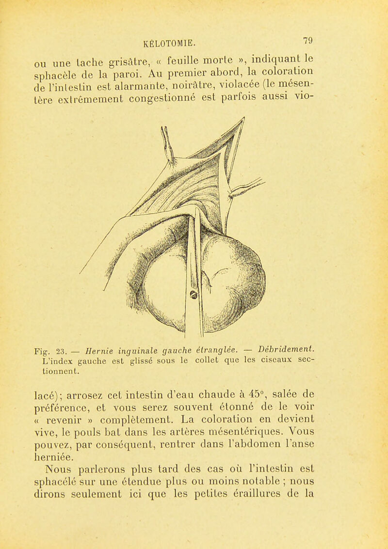KÈLOTOMIE. 'y OU une lâche grisâtre, « feuille morle », indiquant le sphacèle de la paroi. Au premier abord, la coloration de l'inlesLin est alarmante, noirâtre, violacée (le mésen- tère extrêmement congestionné est parfois aussi vio- Fig. 23. — Hernie inguinale gauche étranglée. — Débridement. L'index gauche est glissé sous le collet que les ciseaux sec- tionnent. lacé); arrosez cet intestin d'eau chaude à 45°, salée de préférence, et vous serez souvent étonné de le voir « revenir » complètement. La coloration en devient vive, le pouls bat dans les artères mésentériques. Vous pouvez, par conséquent, rentrer dans l'abdomen l'anse herniée. Nous parlerons plus tard des cas où l'intestin est sphacélé sur une étendue plus ou moins notable ; nous dirons seulement ici que les petites éraillures de la