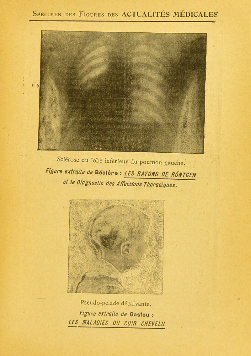 Spécimen des Figures des ACTUALITÉS MÉDICALE? F Sclérose du lobe inférieur du poumon gauche. Figure extraite de Béclère : LES RAYONS DE RÔNT6EN et le Diagnostic des Affections Thoraciques. Pseudo-pelade décalvante. Figure extraite de Gastou : LES m LAD/ES DU CUIR CHEVELU