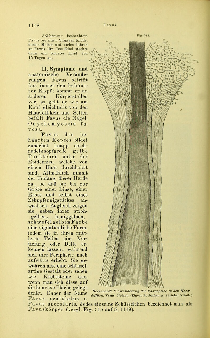 Schleissaer beobachtete Favus bei einem 9tägigen Kinde, dessen Mutter seit vielen Jahren an Favus litt. Das Kind steckte dann ein anderes Kind von ^ 15 Tagen an. II. Symptome und ^.^^ - ^ <i, .^ <,^^^_ anatomische Yerände- ^^^x^K'^S^^.^i^iB^Hi-: rung-en. Favus betrifft fast immer den behaar- ten Kopf; kommt er an anderen Körperstellen vor, so geht er vpie am Kopf gleichfalls von den Haarfollikeln aus. Selten befällt Favus die Nägel, Onychomycosis fa- vosa. Favus des be- haarten Kopfes bildet zunächst knapp steck- nadelknopfgroße gelbe Pünktchen unter der Epidermis, Vielehe von einem Haar durchbohrt sind. Allmählich nimmt der Umfang dieser Herde zu, so daß sie bis zur Größe einer Linse, einer Erbse und selbst eines Zehnpfennigstückes an- w^achsen. Zugleich zeigen sie neben ihrer stroh- gelben , honiggelben, schwefelgelben Farbe eine eigentümliche Form, indem sie in ihren mitt- leren Teilen eine Ver- tiefung oder Delle er- kennen lassen , während sich ihre Peripherie nach aufwärts erhebt. Sie ge- währen also eine schüssel- artige Gestalt oder sehen wie Krebssteine aus, wenn man sich diese auf die konvexe Fläche gelegt denkt. Daher der Name Favus scutulatus s. Favus urceolaris. Jedes einzelne Schüsselchen bezeichnet man als Favuskörper (vergl. Fig. 315 auf S. 1119). Beginnende Einwanderung der Favuspilze in den Ha,a,r- foUikel. Vergr. 275fach. (Eigene Beobachtung. Züricher Klinilt.)