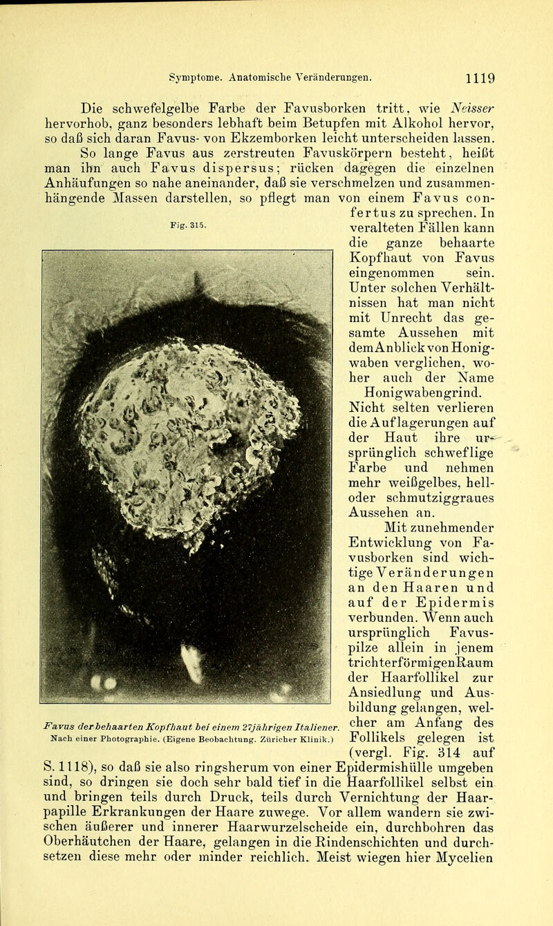 Die schwefelgelbe Farbe der Favusborken tritt, wie Neisser hervorhob, ganz besonders lebhaft beim Betupfen mit Alkohol hervor, so daß sich daran Favus- von Ekzemborken leicht unterscheiden lassen. So lange Favus aus zerstreuten Favuskörpern besteht, heißt man ihn auch Favus dispersus; rücken dagegen die einzelnen Anhäufungen so nahe aneinander, daß sie verschmelzen und zusammen- hängende Massen darstellen, so pflegt man von einem Favus con- fertus zu sprechen. In veralteten Fällen kann die ganze behaarte Kopfhaut von Favus eingenommen sein. Unter solchen Verhält- nissen hat man nicht mit Unrecht das ge- samte Aussehen mit dem Anblick von Honig- waben verglichen, wo- her auch der Name Honig wabengrind. Nicht selten verlieren die Auflagerungen auf der Haut ihre ur- sprünglich schweflige Farbe und nehmen mehr weißgelbes, hell- oder schmutziggraues Aussehen an. Mit zunehmender Entwicklung von Fa- vusborken sind wich- tige Veränderungen an den Haaren und auf der Epidermis verbunden. Wenn auch ursprünglich Favus- pilze allein in jenem trichterförmigenRaum der Haarfollikel zur Ansiedlung und Aus- bildung gelangen, wel- Fa.vusderbehaa.rten Kopfhaut bei einem 27jä.hrigenlta.liener. C^^er am Anfang deS Nach einer Photographie. (Eigene Beobachtung. Züricher Klinik.) Follikels gelegen ist (vergl. Fig. 314 auf S. 1118), so daß sie also ringsherum von einer Epidermishülle umgeben sind, so dringen sie doch sehr bald tief in die Haarfollikel selbst ein und bringen teils durch Druck, teils durch Vernichtung der Haar- papille Erkrankungen der Haare zuwege. Vor allem wandern sie zwi- schen äußerer und innerer Haarwurzelscheide ein, durchbohren das Oberhäutchen der Haare, gelangen in die Rindenschichten und durch- setzen diese mehr oder minder reichlich. Meist wiegen hier Mycelien