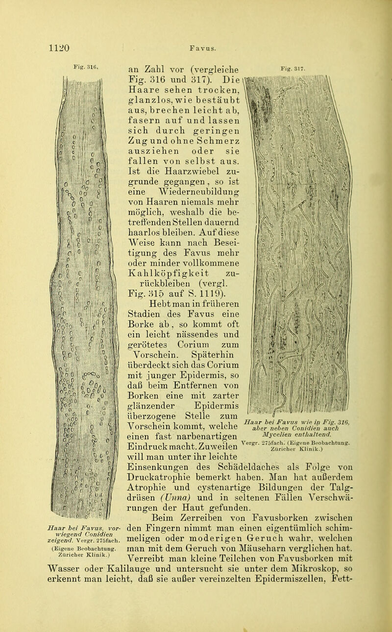Fig. 31G. Fig. an Zahl vor (vergleiche Fig. 316 und 317). Die Haare sehen trocken, glanzlos, wie bestäubt aus, brechen leicht ab, fasern auf und lassen sich durch geringen Zug und ohne Schmerz ausziehen oder sie fallen von selbst aus. Ist die Haarzwiebel zu- grunde gegangen , so ist eine Wiedernoubildung von Haaren niemals mehr möglich, weshalb die be- treffenden Stellen dauernd haarlos bleiben. Auf diese Weise kann nach Besei- tigung des Favus mehr oder minder vollkommene Kahlköpfigkeit zu- rückbleiben (vergl. Fig. 315 auf S. 1119). Hebt man in früheren Stadien des Favus eine Borke ab, so kommt oft ein leicht nässendes und gerötetes Corium zum Vorschein. Späterhin überdeckt sich das Corium mit junger Epidermis, so daß beim Entfernen von Borken eine mit zarter glänzender Epidermis überzogene Stelle zum Vorschein kommt, welche einen fast narbenartigen Eindruck macht. Zuweilen will man unter ihr leichte Einsenkungen des Schädeldaches als Folge von Druckatrophie bemerkt haben. Man hat außerdem Atrophie und cystenartige Bildungen der Talg- drüsen (Unna) und in seltenen Fällen Verschwä- rungen der Haut gefunden. Beim Zerreiben von Favusborken zwischen den Fingern nimmt man einen eigentümlich schim- meligen oder moderigen Geruch wahr, welchen man mit dem Geruch von Mäuseharn verglichen hat. Verreibt man kleine Teilchen von Favusborken mit Wasser oder Kalilauge und untersucht sie unter dem Mikroskop, so erkennt man leicht, daß sie außer vereinzelten Epidermiszellen, Fett- Haar bei Favus ii'/c in Fijr. si'J. aber neben Conidien auch Mycelien entlialtend. Vergr. iTäf.ich. (Kigi-ue Beobachtung. Zürichoi- Klinik.) Haar bei J^avus. vor wiegend Conidien zeigend. Vorgr. 275fach (Eigene Beobachtung. Züricher Klinik.)