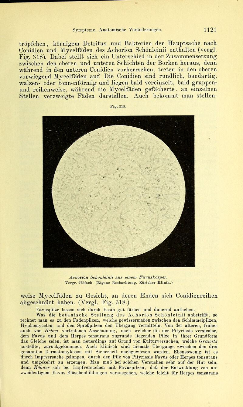 tröpfchen, körnigem Detritus und Bakterien der Haiiptsache nach Conidien und Mycelfäden des Achorion Schönleinii enthalten (vergl. Fig. 318). Dabei stellt sich ein Unterschied in der Zusammensetzung zwischen den oberen und unteren Schichten der Borken heraus, denn während in den unteren Conidien vorherrschen, treten in den oberen vorwiegend Mycelfäden auf. Die Conidien sind rundlich, bandartig, walzen- oder tonnenförmig und liegen bald vereinzelt, bald gruppen- und reihenweise, während die Mycelfäden gefächerte , an einzelnen Stellen verzweigte Fäden darstellen. Auch bekommt man stellen- Fig. 318. Achorion Schönleinii aus einem Fa.vuskörper. Vergr. 275fach. (Eigene Beobachtung. Züricher Klinik.) weise Mycelfäden zu Gesicht, an deren Enden sich Conidienreihen abgeschnürt haben. (Vergl. Fig. 318.) Favuspilze lassen sich durch Eosin gut färben und dauernd aufheben. Was die botanische Stellung des Achorion Schönleinii anbetrifft, so rechnet man es za den Fadenpilzen, welche gewissermaßen zwischen den Schimmelpilzen, Hyphomyceten, und den Sproßpilzen den Übergang vermitteln. Von der älteren, früher auch von Hehra vertretenen Anschauung, nach welcher die der Pityriasis versicolor, dem Favus und dem Herpes tonsurans zugrunde liegenden Pilze in ihrer Grundform das Gleiche seien, ist man neuerdings auf Grund von Kulturversuchen, welche Grawitz anstellte, zurückgekommen. Auch klinisch sind niemals Übergänge zwischen den drei genannten Dermatomykosen mit Sicherheit nachgewiesen worden. Ebensowenig ist es durch Impfversuche gelungen, durch den Pilz von Pityriasis Favus oder Herpes tonsurans und umgekehrt zu erzeugen. Man muß bei solchen Versuchen sehr auf der Hut sein, denn Kölner sah bei Impfversuchen mit Favnspilzen, daß der Entwicklung von un- zweideutigem Favus Bläschenbildungen vorausgehen, welche leicht für Herpes tonsurans