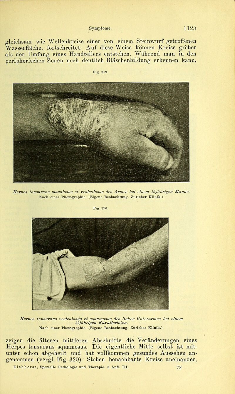 gleichsam wie Wellenkreise einer von einem Steinwnrf getrofienen Wasserfläche, fortschreitet. Auf diese Weise können Kreise größer als der Umfang eines Handtellers entstehen. Während man in den peripherischen Zonen noch deutlich Bläschenbildung erkennen kann, Fig. 319. Herpes tonsurans maculosus et vesicnlosus des Armes bei einem 19jährigen Manne. Nach einer Photographie. (Eigene Beobachtung. Züricher Klinit.) Fig. 320. Herpes tonsurans vesicnlosus et squamosus iles liuki-^n Cnterarmes hei einem 22jährigen Kavalleristen. Nach einer Photographie. (Eigene Beobachtung. Züricher Klinik.) zeigen die älteren mittleren Abschnitte die Veränderungen eines Herpes tonsurans squamosus. Die eigentliche Mitte selbst ist mit- unter schon abgeheilt und hat vollkommen gesundes Aussehen an- genommen (vergl. Fig. 320). Stoßen benachbarte Kreise aneinander, Eichhorst, Spezielle Pathologie und Therapie. 6.Anfl. in. 72