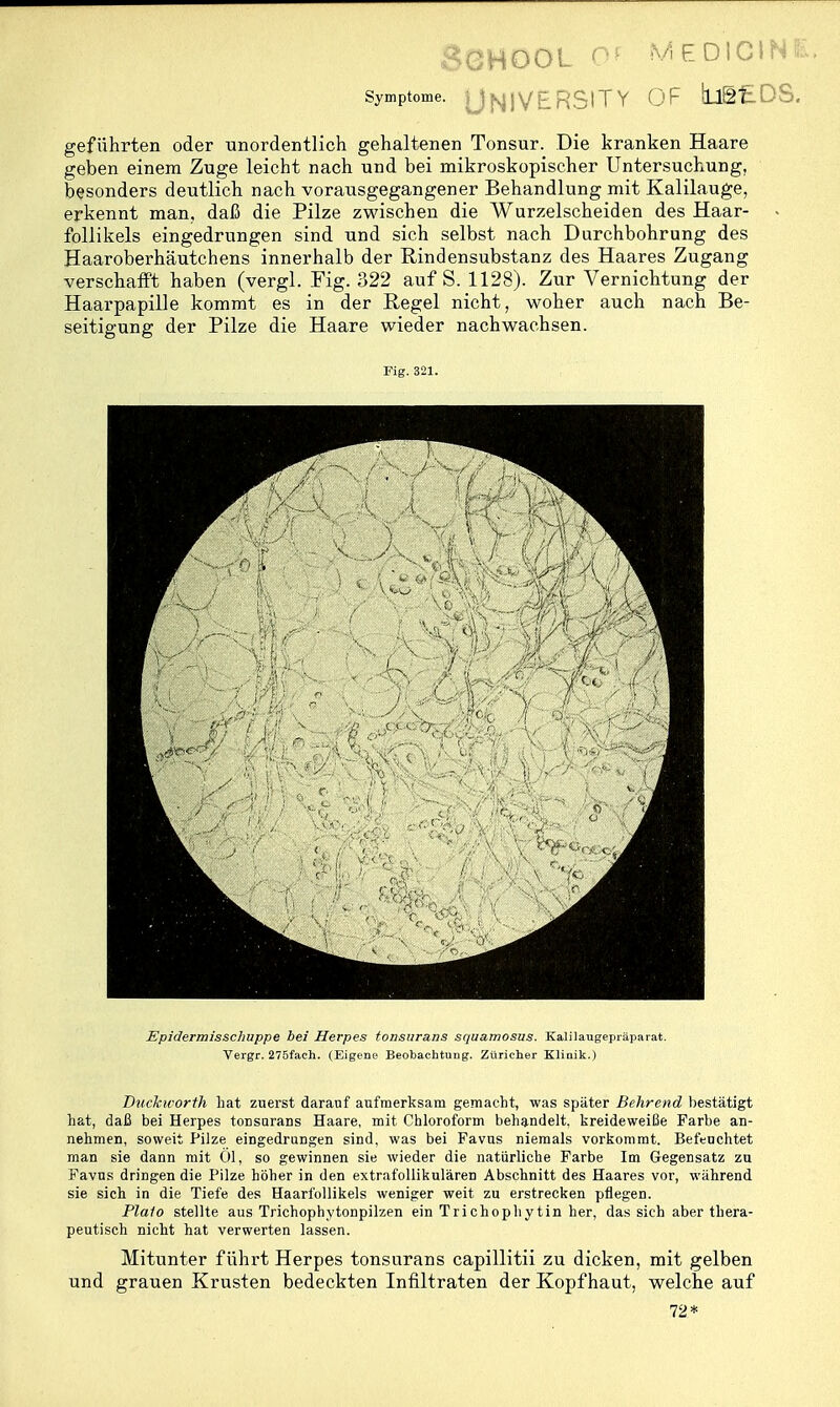 CHOOL ^ MEDiCiNt: Symptome. \ ^ j \J p_ p ß | T Y O F tUgt 0 S. geführten oder unordentlich gehaltenen Tonsur. Die kranken Haare geben einem Zuge leicht nach und bei mikroskopischer Untersuchung, besonders deutlich nach vorausgegangener Behandlung mit Kalilauge, erkennt man, daß die Pilze zwischen die Wurzelscheiden des Haar- follikels eingedrungen sind und sich selbst nach Durchbohrung des Haaroberhäutchens innerhalb der Rindensubstanz des Haares Zugang verschafft haben (vergl. Fig. 322 auf S. 1128). Zur Vernichtung der Haarpapille kommt es in der Regel nicht, woher auch nach Be- seitigung der Pilze die Haare wieder nachwachsen. Mg. 321. Epidermisschuppe bei Herpes tonsura/is squamosus. Kalilaugepräparat. Vergr. 275fach. (Eigene Beobachtung. Züriclier Kliaik.) Duckicorth hat zuerst darauf aufmerksam gemacht, was später Behrend bestätigt hat, daß bei Herpes tonsarans Haare, mit Chloroform behandelt, kreideweiße Farbe an- nehmen, soweit Pilze eingedrungen sind, was bei Favus niemals vorkommt. Befenchtet man sie dann mit Ol, so gewinnen sie wieder die natürliche Farbe Im Gegensatz zu Favus dringen die Pilze höher in den extrafollikulären Abschnitt des Haares vor, während sie sich in die Tiefe des Haarfollikels weniger weit zu erstrecken pflegen. Plaio stellte aus Trichophytonpilzen ein Trichophytin her, das sich aber thera- peutisch nicht hat verwerten lassen. Mitunter führt Herpes tonsurans capillitii zu dicken, mit gelben und grauen Krusten bedeckten Infiltraten der Kopfhaut, welche auf 72*