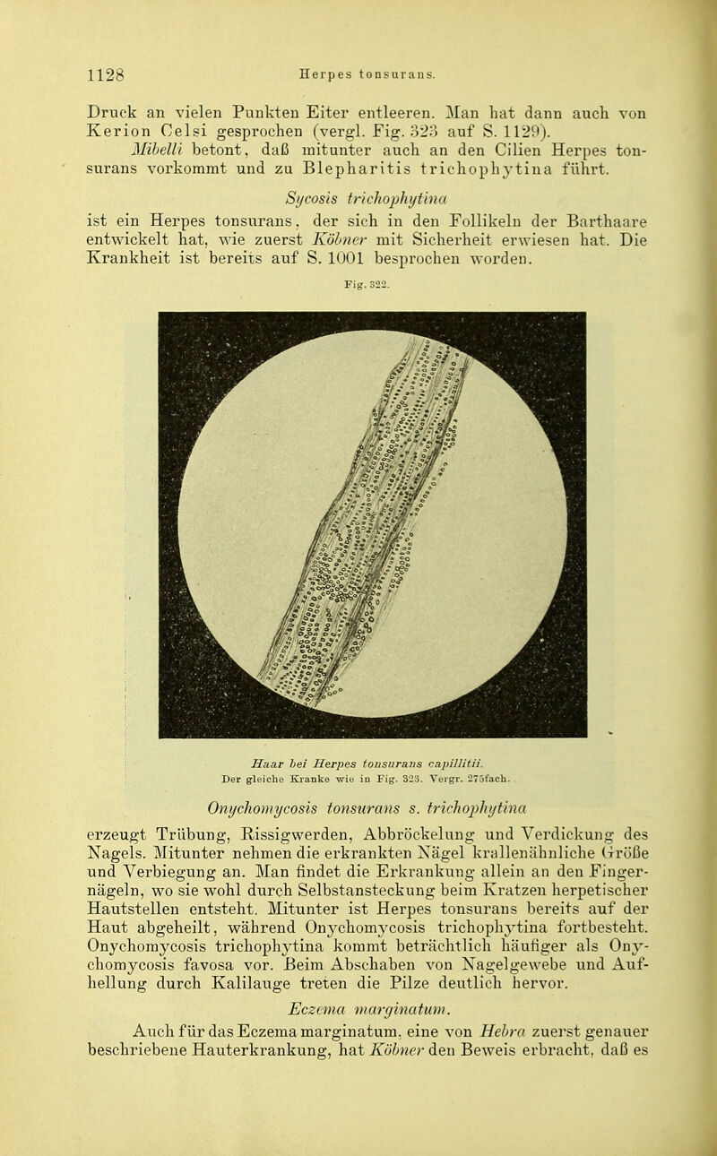 Druck an vielen Punkten Eiter entleeren. Man hat dann auch von Kerion Celsi gesprochen (vergl. Fig. ;>2;') auf S. 1129). Mihelli betont, daß mitunter auch an den Cilien Herpes ton- surans vorkommt und zu Blepharitis trichophytina führt. Sycosis trichophytina ist ein Herpes tonsurans, der sich in den Follikeln der Barthaare entwickelt hat, wie zuerst Köhner mit Sicherheit erwiesen hat. Die Krankheit ist bereits auf S. 1001 besprochen worden. Fig.322. Haar bei Herpes tonsurans capillitii. Der gleiche Kranke wia in Fig. 323. Yeigr. 27-3fach. Onychomycosis tonsurans s. trichophytina erzeugt Trübung, ßissigwerden, Abbröckelung und Verdickung des Nagels. Mitunter nehmen die erkrankten Xägel krallenähnliche (rroße und Verbiegung an. Man findet die Erkrankung allein an den Finger- nägeln, wo sie wohl diirch Selbstansteckung beim Kratzen herpetischer Hautstellen entsteht. Mitunter ist Herpes tonsurans bereits auf der Haut abgeheilt, während Onj^chomycosis trichophytina fortbesteht. Onychomycosis trichophytina kommt beträchtlich häufiger als Ony- chomycosis favosa vor. Beim Abschaben von Xagelgewebe und Auf- hellung durch Kalilauge treten die Pilze deutlich hervor. Eczema marginatunt. Auch für das Eczema marginatum, eine von Hehra zuerst genauer beschriebene Hauterkrankung, hat Köhner den Beweis erbracht, daß es