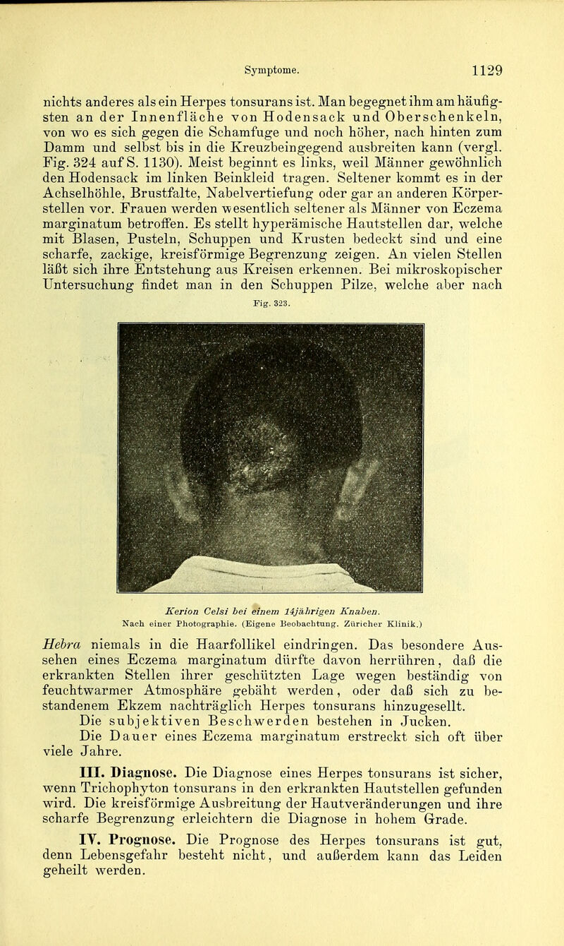 nichts anderes als ein Herpes tonsurans ist. Man begegnet ihm am häufig- sten an der Innenfläche von Hodensack und Oberschenkeln, von wo es sich gegen die Schamfuge und noch höher, nach hinten zum Damm und selbst bis in die Kreuzbeingegend ausbreiten kann (vergl. Fig. 324 auf S. 1130). Meist beginnt es links, weil Männer gewöhnlich den Hodensack im linken Beinkleid tragen. Seltener kommt es in der Achselhöhle, Brustfalte, Nabelvertiefung oder gar an anderen Körper- stellen vor. Frauen werden wesentlich seltener als Männer von Eczema marginatum betroffen. Es stellt hyperämische Hautstellen dar, welche mit Blasen, Pusteln, Schuppen und Krusten bedeckt sind und eine scharfe, zackige, kreisförmige Begrenzung zeigen. An vielen Stellen läßt sich ihre Entstehung aus Kreisen erkennen. Bei mikroskopischer Untersuchung findet man in den Schuppen Pilze, welche aber nach Fig. 323. Kerion Celsi bei einem 14jälirigen Knaben. Nach einer Pliotographie. (Eigene Beobachtung. Züricher Kliniit.) Hehra niemals in die Haarfollikel eindringen. Das besondere Aus- sehen eines Eczema marginatum dürfte davon herrühren, daß die erkrankten Stellen ihrer geschützten Lage wegen beständig von feuchtwarmer Atmosphäre gebäht werden, oder daß sich zu be- standenem Ekzem nachträglich Herpes tonsurans hinzugesellt. Die subjektiven Beschwerden bestehen in Jucken. Die Dauer eines Eczema marginatum erstreckt sich oft über viele Jahre. III. Diagnose. Die Diagnose eines Herpes tonsurans ist sicher, wenn Trichophyton tonsurans in den erkrankten Hautstellen gefunden wird. Die kreisförmige Ausbreitung der Hautveränderungen und ihre scharfe Begrenzung erleichtern die Diagnose in hohem Grade. IV. Prognose. Die Prognose des Herpes tonsurans ist gut, denn Lebensgefahr besteht nicht, und außerdem kann das Leiden geheilt werden.