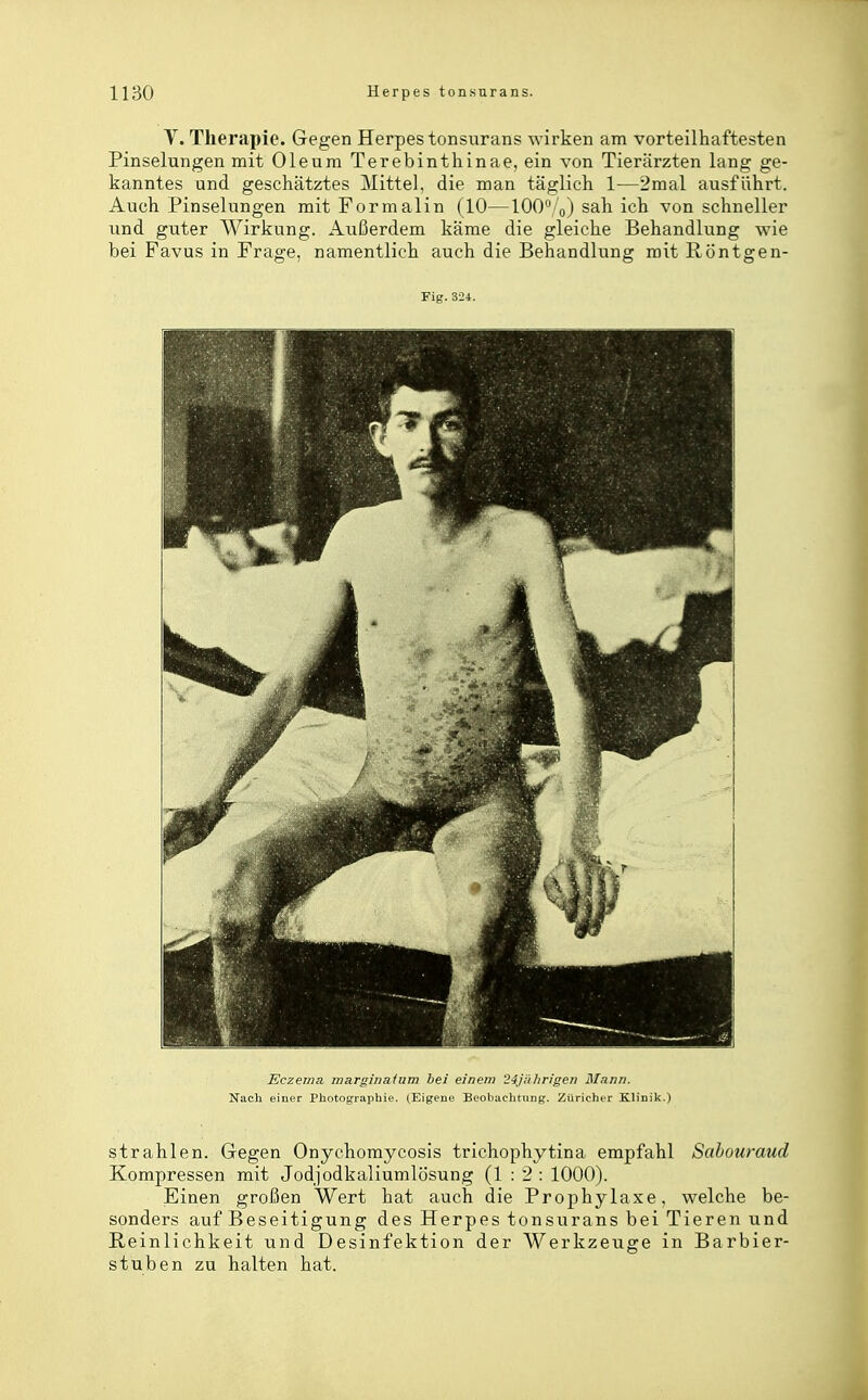 Y. Therapie. Gegen Herpes tonsurans wirken am vorteilhaftesten Pinselungen mit Oleum Terebinthinae, ein von Tierärzten lang ge- kanntes und geschätztes Mittel, die man täglich 1—2mal ausführt. Auch Pinselungen mit Formalin (10—100 „j sah ich von schneller und guter Wirkung. Außerdem käme die gleiche Behandlung wie bei Favus in Frage, namentlich auch die Behandlung mit Röntgen- Fig. 324. Eczema wargiiiatuw bei einem 24j!ihrigen Mann. Nach einer Photographie. (Eigene Beobachtung;. Züricher Klinik.) strahlen. Gegen Onyehomycosis trichophytina empfahl Sahouraud Kompressen mit Jodjodkaliumlösung (1:2: 1000). Einen großen Wert hat auch die Prophylaxe, welche be- sonders auf Beseitigung des Herpes tonsurans bei Tieren und Reinlichkeit und Desinfektion der Werkzeuge in Barbier- stuben zu halten hat.
