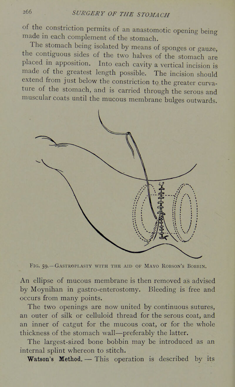 of the_ constriction permits of an anastomotic opening being made m each complement of the stomach. The stomach being isolated by means of sponges or gauze, the contiguous sides of the two halves of the stomach are placed in apposition. Into each cavity a vertical incision is made of the greatest length possible. The incision should extend from just below the constriction to the greater curva- ture of the stomach, and is carried through the serous and muscular coats until the mucous membrane bulges outwards. Fig. 59.—Gastroplasty with the aid of Mayo Robson's Bobbin. An ellipse of mucous membrane is then removed as advised by Moynihan in gastro-enterostomy. Bleeding is free and occurs from many points. The two openings are now united by continuous sutures, an outer of silk or celluloid thread for the serous coat, and an inner of catgut for the mucous coat, or for the whole thickness of the stomach wall—preferably the latter. The largest-sized bone bobbin may be introduced as an internal splint whereon to stitch. Watson's Method. — This operation is described by its