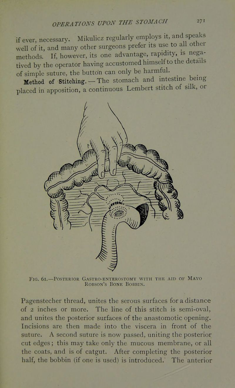 if ever, necessary. Mikulicz regularly employs it, and speaks Nvell of it, and many other surgeons prefer its use to all other methods. If, however, its one advantage, rapidity, is nega- tived by the operator having accustomed himself to the details of simple suture, the button can only be harmful. Method of Stitching. — The stomach and intestine being placed in apposition, a continuous Lembert stitch of silk, or Fig, 61.—Posterior Gastro-enterostomy with thic aid ok Mayo Robson's Bone Bobbin. Pagenstecher thread, unites the serous surfaces for a distance of 2 inches or more. The line of this stitch is semi-oval, and unites the posterior surfaces of the anastomotic opening. Incisions are then made into the viscera in front of the suture. A second suture is now passed, uniting the posterior cut edges; this may take only the mucous membrane, or all the coats, and is of catgut. After completing the posterior half, the bobbin (if one is used) is introduced. The anterior