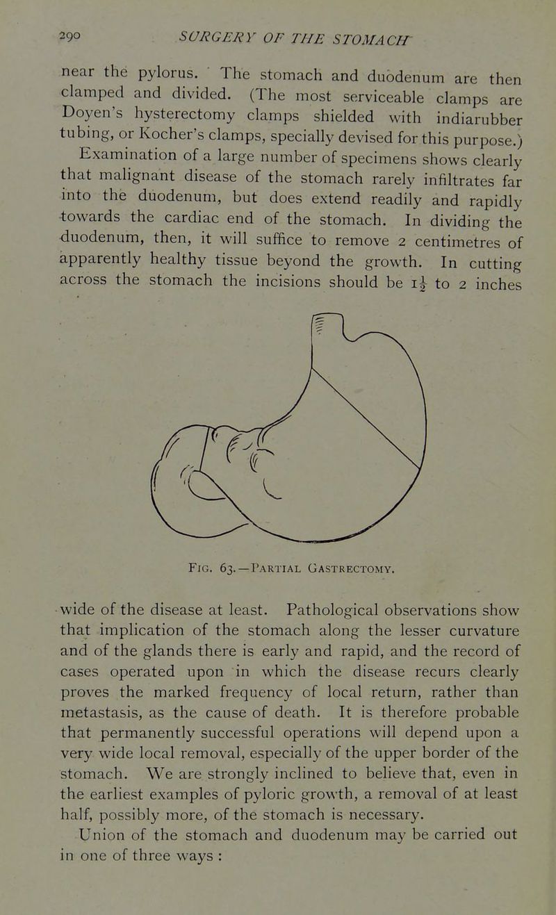 near the pylorus. The stomach and duodenum are then clamped and divided. (The most serviceable clamps are Doyen's hysterectomy clamps shielded with indiarubber tubing, or Kocher's clamps, specially devised for this purpose.) Examination of a large number of specimens shows clearly that malignant disease of the stomach rarely infiltrates far into the duodenum, but does extend readily and rapidly ■towards the cardiac end of the stomach. In dividing the duodenum, then, it will suffice to remove 2 centimetres of apparently healthy tissue beyond the growth. In cutting across the stomach the incisions should be to 2 inches Fig. 63.—Partial Gastrectomy. wide of the disease at least. Pathological observations show that implication of the stomach along the lesser curvature and of the glands there is early and rapid, and the record of cases operated upon in which the disease recurs clearly proves the marked frequency of local return, rather than metastasis, as the cause of death. It is therefore probable that permanently successful operations will depend upon a very wide local removal, especially of the upper border of the stomach. We are strongly inclined to believe that, even in the earliest examples of pyloric growth, a removal of at least half, possibly more, of the stomach is necessary. Union of the stomach and duodenum may be carried out in one of three ways :