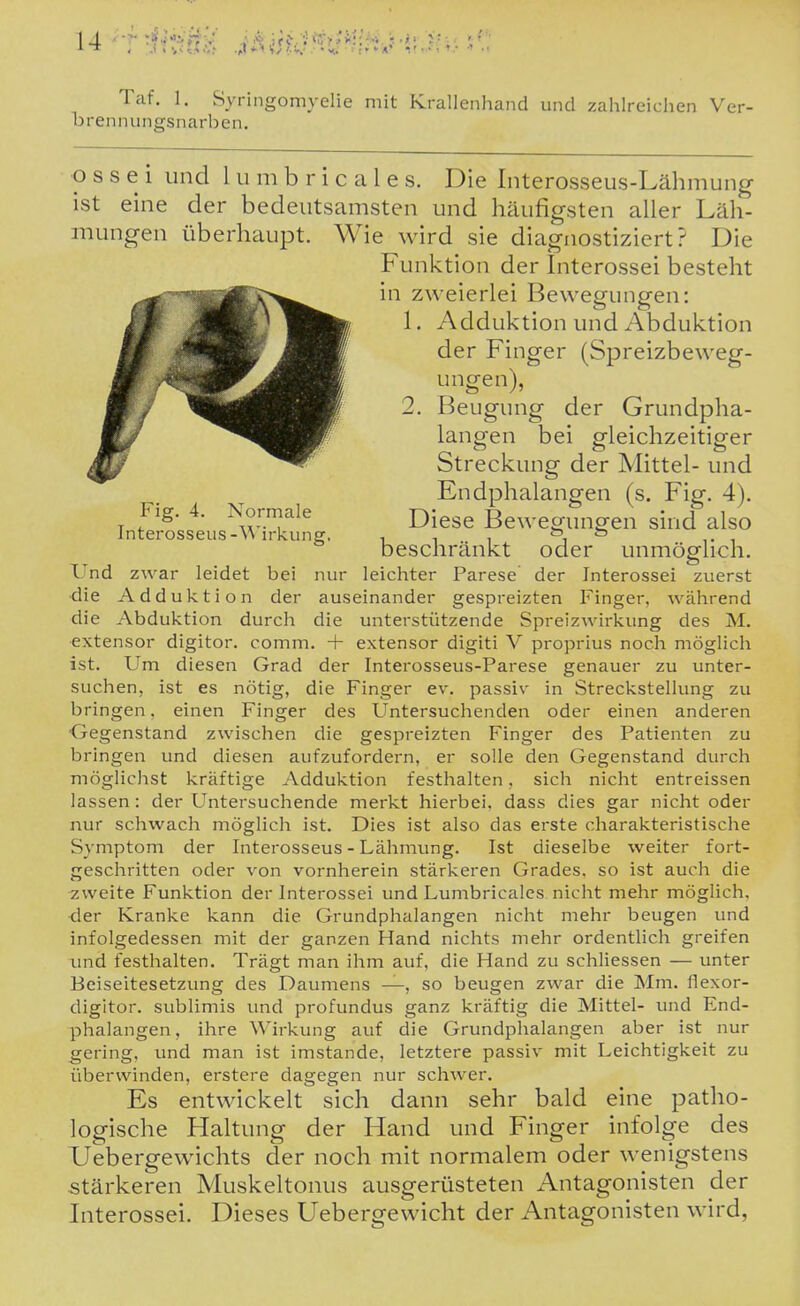 * » •*> «!* «>J Taf. 1. Syringomyelie mit Krallenhand und zahlreichen Ver- brennungsnarben. o s s e i und 1 u m b r i c a 1 e s. Die Interosseus-Lähmung ist eine der bedeutsamsten und häufigsten aller Läh- mungen überhaupt. Wie wird sie diagnostiziert? Die Funktion der Interossei besteht in zweierlei Bewegungen: 1. Adduktion und i\bduktion der Finger (Spreizbeweg- ungen), 2. Beugung der Grundpha- langen bei gleichzeitiger Streckung der Mittel- und Endphalangen (s. Fig. 4). Fig. 4. Normale j^-^^^^ Bewegungen sind also lnterosseus-\N n-kung. i i i ^ ^ ^• ^ beschränkt oder unmöglich. Und zwar leidet bei nur leichter Parese der Interossei zuerst die Adduktion der auseinander gespreizten Finger, während die Abduktion durch die unterstützende Spreizwirl^ung des M. extensor digitor. comm. + extensor digiti V proprius noch möglich ist. Um diesen Grad der Interosseus-Parese genauer zu unter- suchen, ist es nötig, die Finger ev. passiv in Streckstellung zu bringen, einen Finger des Untersuchenden oder einen anderen ■Gegenstand zwischen die gespreizten Finger des Patienten zu bringen und diesen aufzufordern, er solle den Gegenstand durch möglichst kräftige Adduktion festhalten, sich nicht entreissen lassen: der Untersuchende merkt hierbei, dass dies gar nicht oder nur schwach möglich ist. Dies ist also das erste charakteristische Symptom der Interosseus-Lähmung. Ist dieselbe weiter fort- geschritten oder von vornherein stärkeren Grades, so ist auch die zweite Funktion der Interossei und Lumbricales nicht mehr möglich, ■der Kranke kann die Grundphalangen nicht mehr beugen und infolgedessen mit der ganzen Hand nichts mehr ordentlich greifen und festhalten. Trägt man ihm auf, die Hand zu schliessen — unter Eeiseitesetzung des Daumens —, so beugen zwar die Mm. flexor- digitor. sublimis und profundus ganz kräftig die Mittel- und End- phalangen, ihre Wirkung auf die Grundphalangen aber ist nur gering, und man ist imstande, letztere passiv mit Leichtigkeit zu überwinden, erstere dagegen nur schwer. Es entwickelt sich dann sehr bald eine patho- logische Haltung der Hand und Finger infolge des Uebergewichts der noch mit normalem oder wenigstens stärkeren Muskeltonus ausgerüsteten Antagonisten der Interossei. Dieses Uebergewicht der Antagonisten wird,