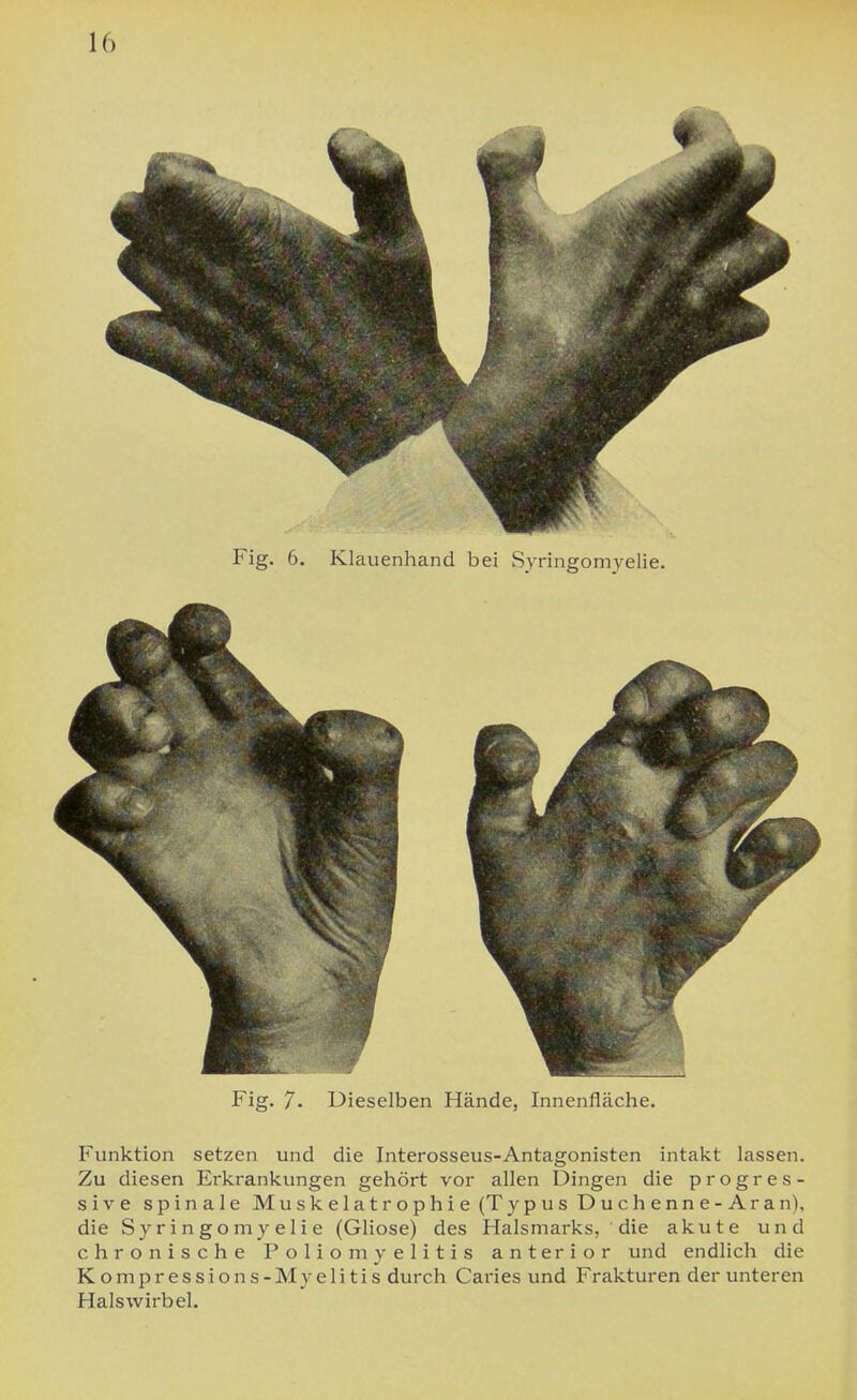 10 Fig. 6. Klauenhand bei Syringomyelie. Fig. 7. Dieselben Hände, Innenfläche. Funktion setzen und die Interosseus-Antagonisten intakt lassen. Zu diesen Erkrankungen gehört vor allen Dingen die progres- sive spinale Muskelatrophie (Typus Duchenne-Aran). die Syringomyelie (Gliose) des Halsmarks, die akute und chronische Poliomyelitis anterior und endlich die Kompressions-Myelitis durch Caries und Frakturen der unteren Halswirbel.