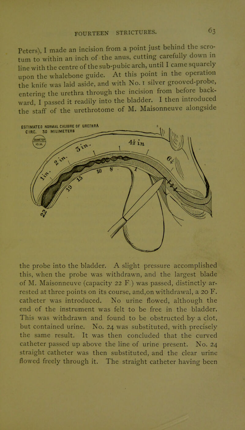 FOURTEEN STRICTURES. Peters) I made an incision from a point just behind the scro- tum to'within an inch of the anus, cutting carefully down m line with the centre of the sub-pubic arch, until I came squarely upon the whalebone guide. At this point in the operation the knife was laid aside, and with No. i silver grooved-probe, entering the urethra through the incision from before back- ward, I^passed it readily into the bladder. I then introduced the staff of the urethrotome of M. Maisonneuve alongside the probe into the bladder. A slight pressure accomplished this, when the probe was withdrawn, and the largest blade of M. Maisonneuve (capacity 22 F.) was passed, distinctly ar- rested at three points on its course, and,on withdrawal, a 20 F. catheter was introduced. No urine flowed, although the end of the instrument was felt to be free in the bladder. This was withdrawn and found to be obstructed by a clot, but contained urine. No. 24 was substituted, with precisely the same result. It was then concluded that the curved catheter passed up above the line of urine present. No. 24 straight catheter was then substituted, and the clear urine flowed freely through it. The straight catheter having been