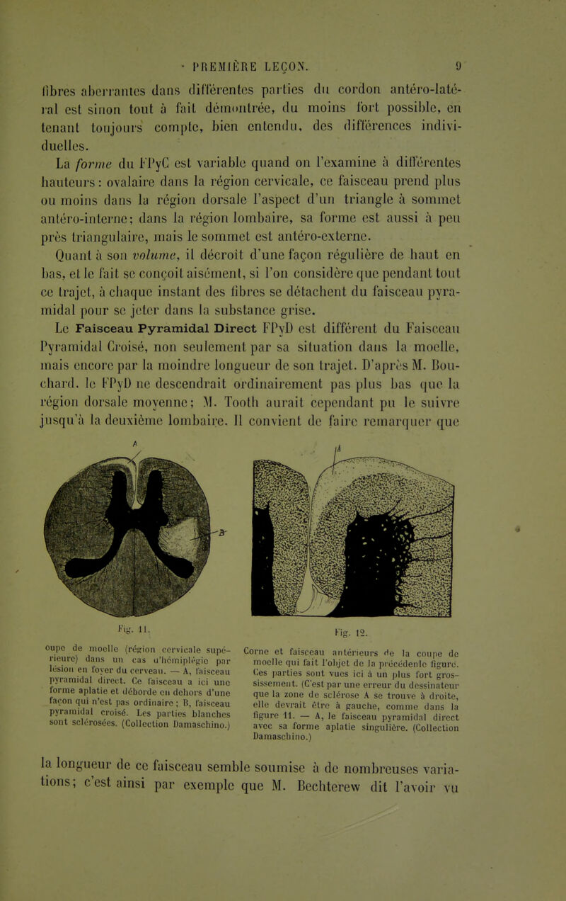 libres aberrantes dans différentes parties du cordon antéro-Iaté* rai est sinon tout à fait démontrée, du moins fort possible, en tenant toujours compte, bien entendu, des différences indivi- duelles. La forme du FPyC est variable quand on l'examine à dillérentes liauteurs : ovalaire dans la région cervicale, ce faisceau prend plus ou moins dans la région dorsale l'aspect d'un triangle à sommet antéro-interne; dans la région lombaire, sa forme est aussi à peu près triangulaire, mais le sommet est antéro-externe. Quant à son volume, il décroit d'une façon régulière de haut en bas, et le fait se conçoit aisément, si l'on considère que pendant tout ce trajet, à chaque instant des fibres se détachent du faisceau pyra- midal pour se jeter dans la substance grise. Le Faisceau Pyramidal Direct FPyD est différent du Faisceau Pyramidal Croisé, non seulement par sa situation dans la moelle, mais encore par la moindre longueur de son trajet. D'après M. Bou- chard, le FPyD ne descendrait ordinairement pas plus bas que la région dorsale moyenne; M. Tooth aurait cependant pu le suivre jusqu'à la deuxième lombaire. Il convient de faire remarquer que Fis. 11. oupe de moelle (région cervicale supé- rieure) dans un cas d'hémiplégie par lésion en foyer du cerveau. — A, faisceau pyramidal direct. Ce faisceau a ici une forme aplatie et déborde en dehors d'une façon qui n'est pas ordinaire; B, faisceau pyramidal croisé. Les parties blanches sont sclérosées. (Collection Damaschino.) Fig. 12. Corne et faisceau antérieurs de la coupe de moelle qui fait l'objet de la prccédenlc figure. Ces parties sont vues ici à un plus fort gros- sissement. (C'est par une erreur du dessinateur que la zone de sclérose A se trouve à droite, elle devrait être à gauche, comme dans la figure 11. — A, le faisceau pyramidal direct avec sa forme aplatie singulière. (Collection Damaschino.) la longueur de ce faisceau semble soumise à de nombreuses varia- tions; c'est ainsi par exemple que M. Bechterew dit l'avoir vu