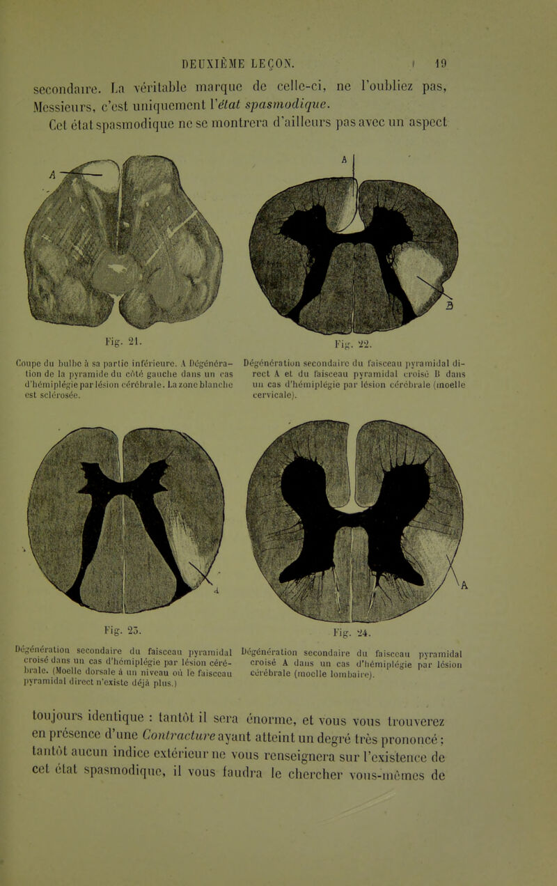 secondaire. La véritable marque de celle-ci, ne l'oubliez pas, Messieurs, c'est uniquement Y état spasmodique. Cel état spasmodique ne se montrera d'ailleurs pas avec un aspect Kg. 21. Coupe du bulbe à sa partie inférieure. A Dégénéra- lion de la pyramide du coté gauche dans un cas d'hémiplégie par lésion cérébrale. La zone blanche est sclérosée. Fig. 23. Dégéncration secondaire du faisceau pyramidal di- rect A et du faisceau pyramidal croisé 11 dans un cas d'hémiplégie par lésion cérébrale (moelle cervicale). Fig. '24. •génération secondaire du faisceau pyramidal Dégénération secondaire du faisceau pyramidal croisé dans un cas d'hémiplégie par lésion céré- croisé A dans un cas d'hémiplégie par lésion bralc. (Moelle dorsale à un niveau où le faisceau cérébrale (moelle lombaire) pyramidal direct n'existe déjà plus.) toujours identique : tantôt il sera énorme, et vous vous trouverez en présence d'une Contracture ayant atteint un degré très prononcé ; tantôt aucun indice extérieur ne vous renseignera sur l'existence de ecl état spasmodique, il vous faudra le chercher vous-mêmes de
