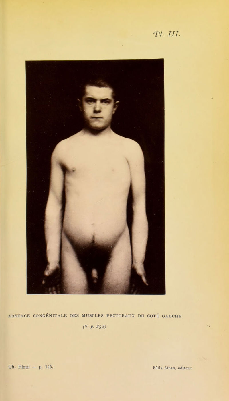 T/. ///. ABSENCE CONGÉNITALE DES MUSCLES PECTORAUX DU COTÉ GAUCHE (V. p. 393) Ch. FÉRK — p. 145. Félix Alcan, éditeur