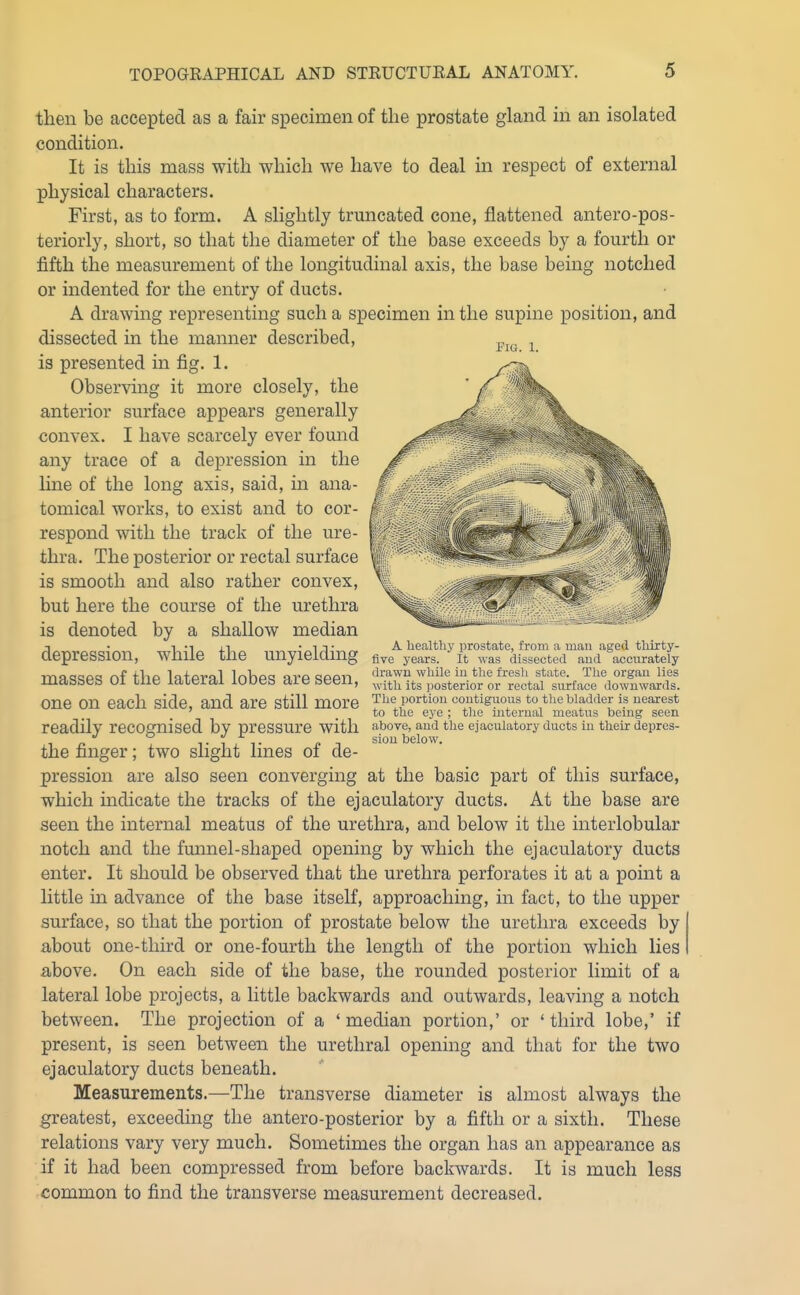 then be accepted as a fair specimen of the prostate gland in an isolated condition. It is this mass with which we have to deal in respect of external physical characters. First, as to form. A slightly truncated cone, flattened antero-pos- teriorly, short, so that the diameter of the base exceeds by a fourth or fifth the measurement of the longitudinal axis, the base being notched or indented for the entry of ducts. A drawing representing such a specimen in the supine position, and dissected in the manner described, is presented in fig. 1. Observing it more closely, the anterior surface appears generally convex. I have scarcely ever found any trace of a depression in the Hne of the long axis, said, in ana- tomical works, to exist and to cor- respond with the track of the ure- thra. The posterior or rectal surface is smooth and also rather convex, but here the course of the urethra is denoted by a shallow median depression, while the unyielding masses of the lateral lobes are seen, one on each side, and are still more readily recognised by pressure with the finger; two slight lines of de- pression are also seen converging at the basic part of this surface, which indicate the tracks of the ejaculatory ducts. At the base are seen the internal meatus of the urethra, and below it the interlobular notch and the funnel-shaped opening by which the ejaculatory ducts enter. It should be observed that the urethra perforates it at a point a little in advance of the base itself, approaching, in fact, to the upper surface, so that the portion of prostate below the urethra exceeds by about one-third or one-fourth the length of the portion which lies above. On each side of the base, the rounded posterior limit of a lateral lobe projects, a little backwards and outwards, leaving a notch between. The projection of a ' median portion,' or ' third lobe,' if present, is seen between the urethral opening and that for the two ejaculatory ducts beneath. Measurements.—The transverse diameter is almost always the greatest, exceeding the antero-posterior by a fifth or a sixth. These relations vary very much. Sometimes the organ has an appearance as if it had been compressed from before backwards. It is much less common to find the transverse measurement decreased. Pig. 1. A healtlij' prostate, from a mau aged tliirty- five years. It was dissected and accurately drawn while in the fresli state. The organ lies with its posterior or rectal surface downwards. The portion contiguous to the bladder is nearest to the eye ; the internal meatus being seen above, and the ejaculatory ducts in their depres- sion below.