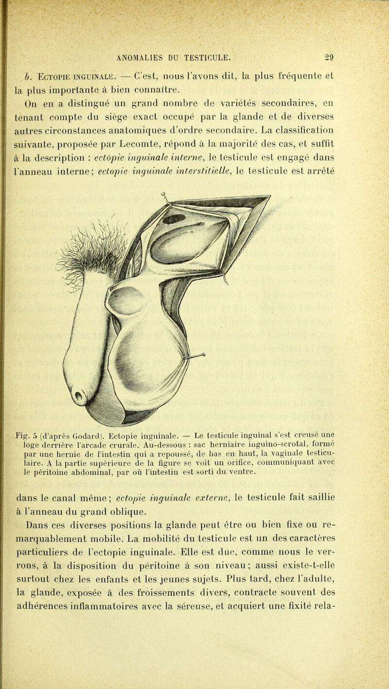 b. EcTOPiE iNGuiNALii. — C'est, nous l'avons dit, la plus fréquente et la plus importante à bien connaître. On en a distingué un grand nombre de variétés secondaires, en tenant compte du siège exact occupé par la glande et de diverses autres circonstances anatomiques d'ordre secondaire. La classification suivante, proposée par Lecomte, répond à la majorité des cas, et suffit à la description : ectôpie inguinale interne, le testicule est engagé dans l'anneau interne; ectopie inguinale interstitielle, le testicule est arrêté Fig. 5 (d'après Godard). Ectopie inguinale. — Le testicule inguinal s'est creusé une loge derrière l'arcade crurale. Au-dessous : sac herniaire inguino-scrotal, formé par une hernie de l'intestin qui a repoussé, de bas en haut, la vaginale testicu- laire. A la partie supérieure de la figure se voit un orifice, communiquant avec le péritoine abdominal, par oii l'intestin est sorti du ventre. dans le canal même ; ectopie inguinale exter7ie, le testicule fait saillie à l'anneau du grand oblique. Dans ces diverses positions la glande peut être ou bien fixe ou re- marquablement mobile. La mobilité du testicule est un des caractères particuliers de l'ectopie inguinale. Elle est due, comme nous le ver- rons, à la disposition du péritoine à son niveau ; aussi existe-t-elle surtout chez les enfants et les jeunes sujets. Plus tard, chez f adulte, la glande, exposée à des froissements divers, contracte souvent des adhérences inflammatoires avec la séreuse, et acquiert une fixité rela-