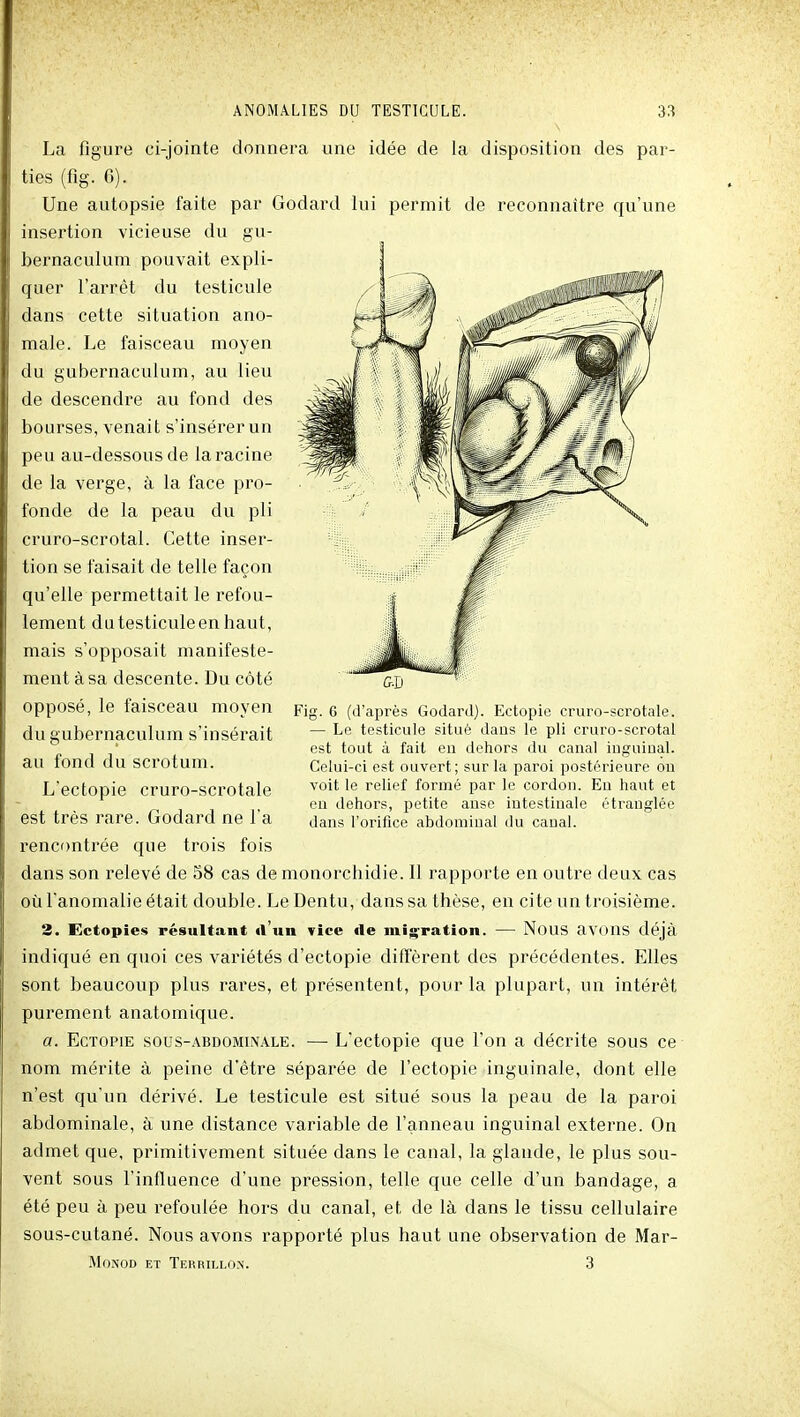 La figure ci-jointe donnera une idée de la disposition des par- ties (flg. G). Une autopsie faite par Godard lui permit de reconnaître qu'une insertion vicieuse du gu- bernaculum pouvait expli- quer l'arrêt du testicule dans cette situation ano- male. Le faisceau moyen du gubernaculum, au lieu de descendre au fond des bourses, venait s'insérer un peu au-dessous de la racine de la verge, à la face pro- fonde de la peau du pli cruro-scrotal. Cette inser- tion se faisait de telle façon qu'elle permettait le refou- lement du testicule en haut, mais s'opposait manifeste- ment à sa descente. Du côté opposé, le faisceau moyen du gubernaculum s'insérait Fig. 6 (d'après Godard). Ectopie cruro-scrotale. — Le testicule situé daus le pli cruro-scrotal est tout à fait eu dehors du canal inguinal. Celui-ci est ouvert; sur la paroi postérieure on voit le relief formé par le cordon. Eu haut et en dehors, petite anse intestinale étranglée dans l'orifice abdominal du canal. au fond du scrotum. L'ectopie cruro-scrotale est très rare. Godard ne l'a rencontrée que trois fois dans son relevé de 58 cas de monorchidie. 11 rapporte en outre deux cas où l'anomalie était double. Le Dentu, dans sa thèse, en cite un troisième. 3. Ectopies résultant «l'un vice de mi^^ration. — NouS avons déjà indiqué en quoi ces variétés d'ectopie diffèrent des précédentes. Elles sont beaucoup plus rares, et présentent, pour la plupart, un intérêt purement anatomique. a. EcTOPiE sous-ABDOMiNALE. •— L'ectopie que l'on a décrite sous ce nom mérite à peine d'être séparée de l'ectopie inguinale, dont elle n'est qu'un dérivé. Le testicule est situé sous la peau de la paroi abdominale, à une distance variable de l'anneau inguinal externe. On admet que, primitivement située dans le canal, la glande, le plus sou- vent sous l'influence d'une pression, telle que celle d'un bandage, a été peu à peu refoulée hors du canal, et de là dans le tissu cellulaire sous-cutané. Nous avons rapporté plus haut une observation de Mar-