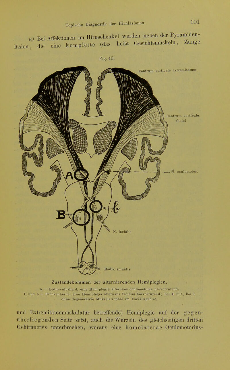 a) Bei Affektionen im Hirnschenkel weiden neben der Pyramiden- Iiision, die eine komplette (das heißt Gesichtsmuskeln, Zunge Fig. 40. Centrum corticale oxtreinitatum Centium corticale faciei — ■ M ■ — IV ocnlomotor. Badix spinalis Zustandekommen der alternierenden Hemiplegien. A = Pedunculushertl, eine Hemiplegia alternans oculomotoria hervorrufend. B und h — BrUckenherde, eine Hemiplegia alternans facialis hervorrufend; bei B mit, bei b ohne degenerative Mnskolatrophie im Facinlisgebiet. und Extremitätenmuskulatur betreffende) Hemiplegie auf der gegen- überliegenden Seite setzt, auch die Wurzeln des gleichseitigen dritten Gehirnnervs unterbrochen, woraus eine homolaterae Oculoniotorius-