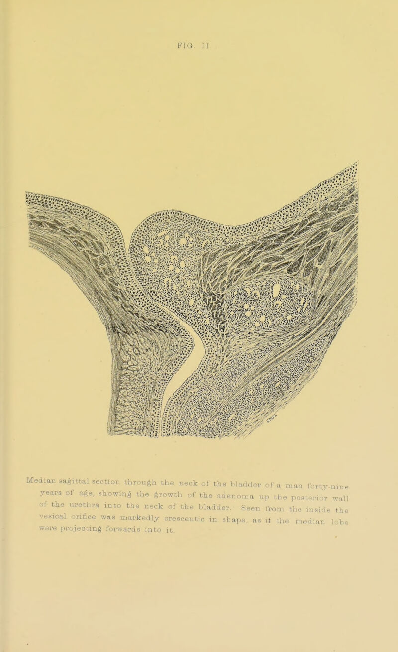 F1G-. 11 Median sa.Aittal section through the neck ol the 1.ladder of a man ibrhy.nmP years of age, showin.^ the Arowth of the adenoma up t.he posio.rior w:Ul of the urethra in do the neck of the bladcler. 8een fi-om the inside t he vesical orifice was markedly crescentic m shape, ,f ihe median )r.h^ were proiectinA forwards into it.