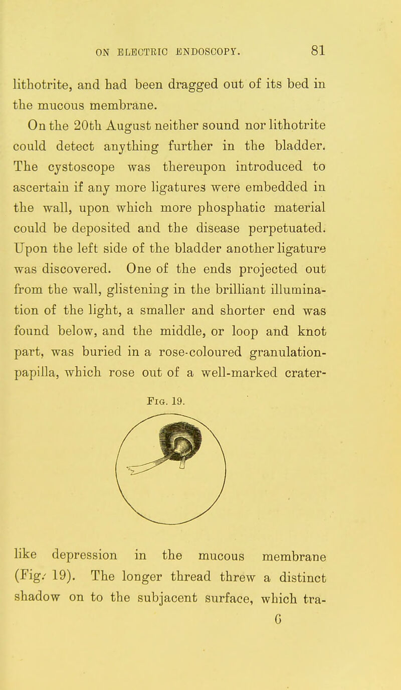 lithotrite, and had been dragged out of its bed in the mucous membrane. On the 20th August neither sound nor lithotrite could detect anything further in the bladder. The cjstoscope was thereupon introduced to ascertain if any more ligatures were embedded in the wall, upon which more phosphatic material could be deposited and the disease perpetuated. Upon the left side of the bladder another ligature was discovered. One of the ends projected out from the wall, glistening in the brilliant illumina- tion of the light, a smaller and shorter end was found below, and the middle, or loop and knot part, was buried in a rose-coloured granulation- papilla, which rose out of a well-marked crater- FiG. 19. like depression in the mucous membrane (Fig.' 19). The longer thread threw a distinct shadow on to the subjacent surface, which tra- G