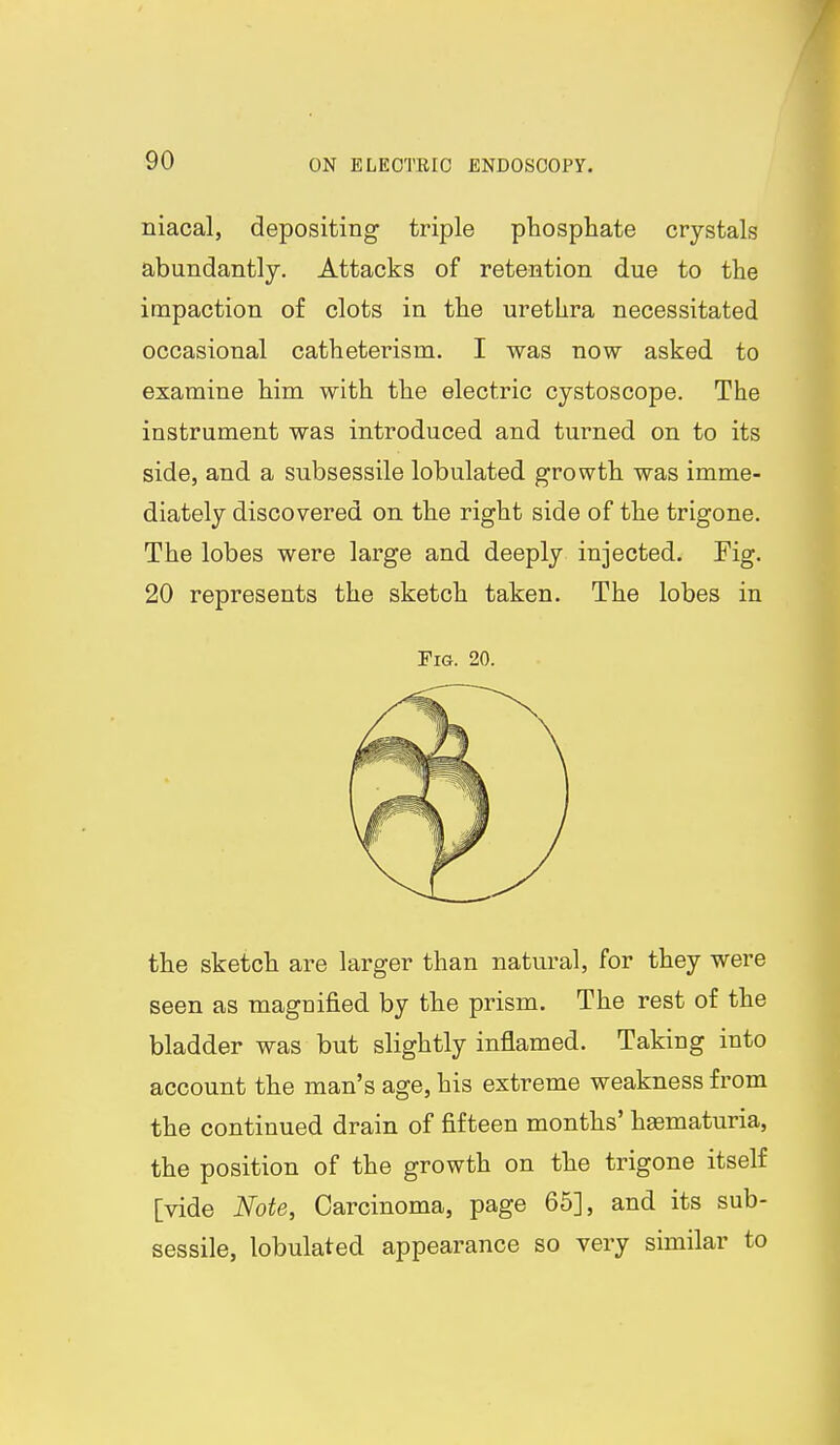 niacal, depositing triple phosphate crystals abundantly. Attacks of retention due to the impaction of clots in the urethra necessitated occasional catheterism. I was now asked to examine him with the electric cystoscope. The instrument was introduced and turned on to its side, and a subsessile lobulated growth was imme- diately discovered on the right side of the trigone. The lobes were large and deeply injected. Fig. 20 represents the sketch taken. The lobes in Fig. 20. the sketch are larger than natural, for they were seen as magnified by the prism. The rest of the bladder was but slightly inflamed. Taking into account the man's age, his extreme weakness from the continued drain of fifteen months' hematuria, the position of the growth on the trigone itself [vide Note, Carcinoma, page 65], and its sub- sessile, lobulated appearance so very similar to