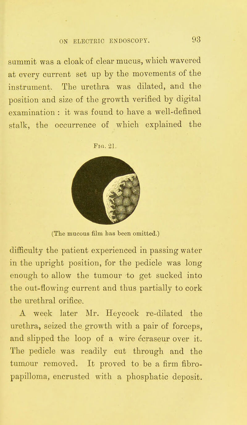 sammit was a cloak of clear mucus, wbich wavered at every current set up by the movements of the instrument. The urethra was dilated, and the position and size of the growth verified by digital examination : it was found to have a well-defined stalk, the occurrence of which explained the Fig. 21. (The mucous film has been omitted.) diflBculty the patient experienced in passing water in the upright position, for the pedicle was long enough to allow the tumour to get sucked into the out-flowing current and thus partially to cork the urethral orifice. A week later Mr. Heycock re-dilated the urethra, seized the growth with a pair of forceps, and slipped the loop of a wire ecraseur over it. The pedicle was readily cut through and the tumour removed. It proved to be a firm fibro- papilloma, encrusted with a phosphatic deposit.