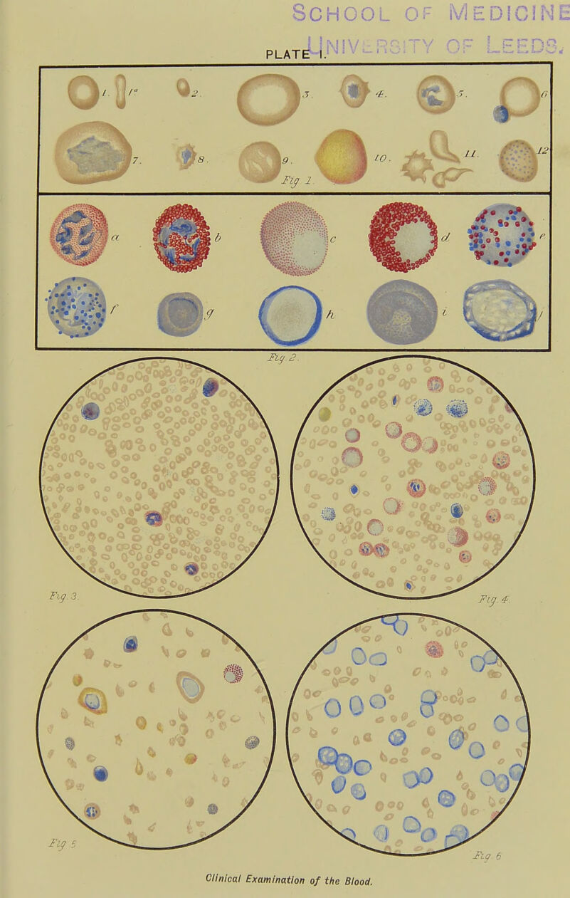 School of Medicin PLATE I.' ^=  - ' ' - ' ^^^^^ ^ ©' ♦ • • He/ 2 ^ ■ «,-••» J« » • V ''^ Clinical Examination of the Blood.